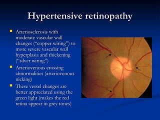 Hypertensive retinopathy
Hypertensive retinopathy
 Arteriosclerosis with
Arteriosclerosis with
moderate vascular wall
moderate vascular wall
changes (“copper wiring”) to
changes (“copper wiring”) to
more severe vascular wall
more severe vascular wall
hyperplasia and thickening
hyperplasia and thickening
(“silver wiring”)
(“silver wiring”)
 Arteriovenous crossing
Arteriovenous crossing
abnormalities (arteriovenous
abnormalities (arteriovenous
nicking)
nicking)
 These vessel changes are
These vessel changes are
better appreciated using the
better appreciated using the
green light (makes the red
green light (makes the red
retina appear in grey tones)
retina appear in grey tones)
 