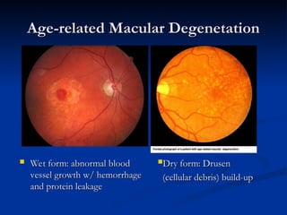Age-related Macular Degenetation
Age-related Macular Degenetation
 Wet form: abnormal blood
Wet form: abnormal blood
vessel growth w/ hemorrhage
vessel growth w/ hemorrhage
and protein leakage
and protein leakage
Dry form: Drusen
Dry form: Drusen
(cellular debris) build-up
(cellular debris) build-up
 