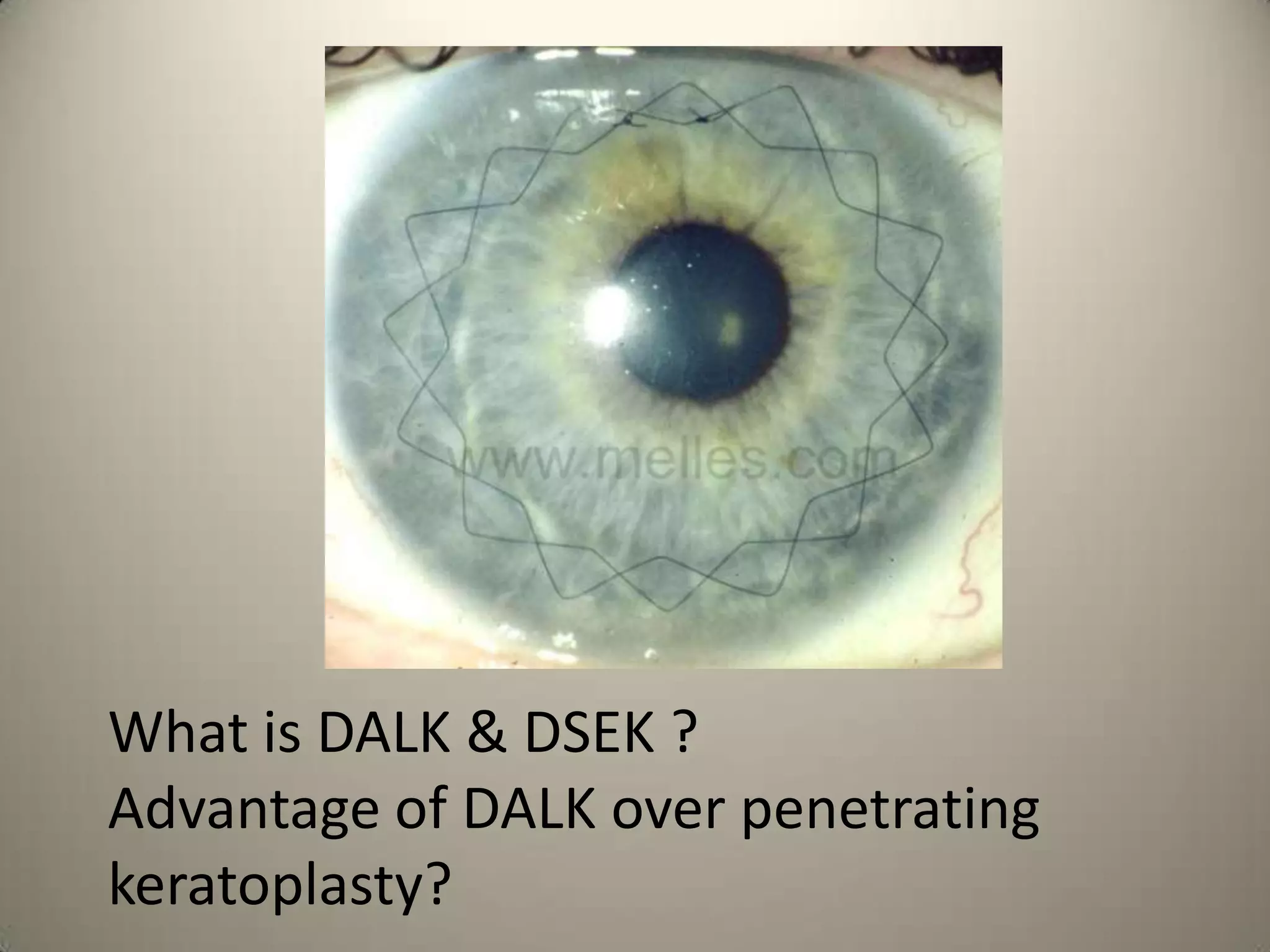 For how many days can we store the corneoscleral button in this medium ?