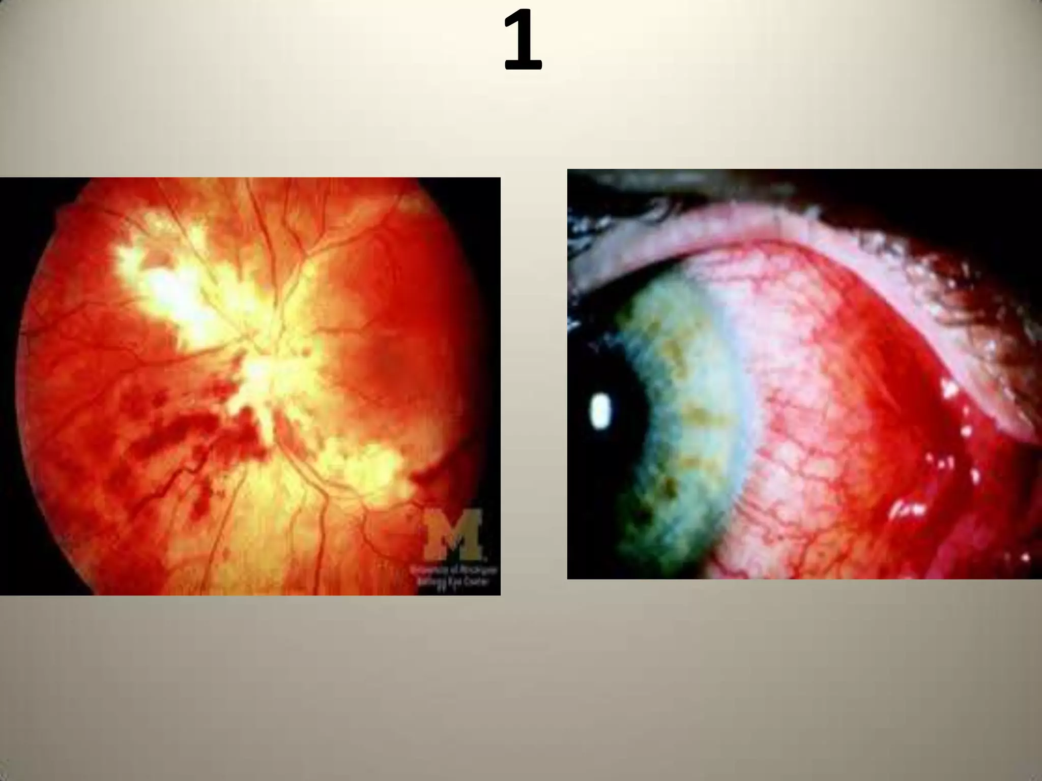 VON GRAEFEINVENTED  VON GRAEFE KNIFE FOR CATARACTEXTRACTION , MADE CONTRIBUTIONS TO GLAUCOMA SURGERIES