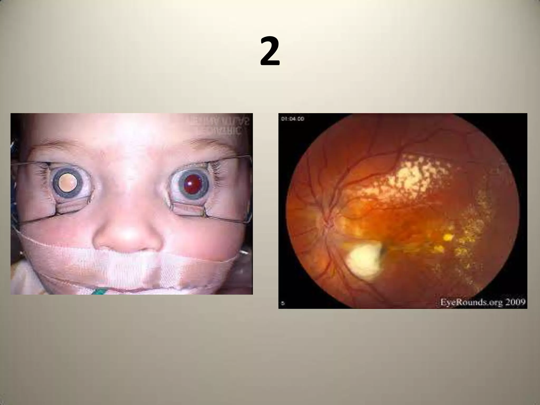ROUND 2& 3: SYSTEMIC ASSOCIATIONS Systemic conditions with ophthal manifestationsIdentification of condition carries 10 pointsEach question carries 5 pointsTOTAL                        20 POINTSOn passing 5 for diagnosis & 3 for each question