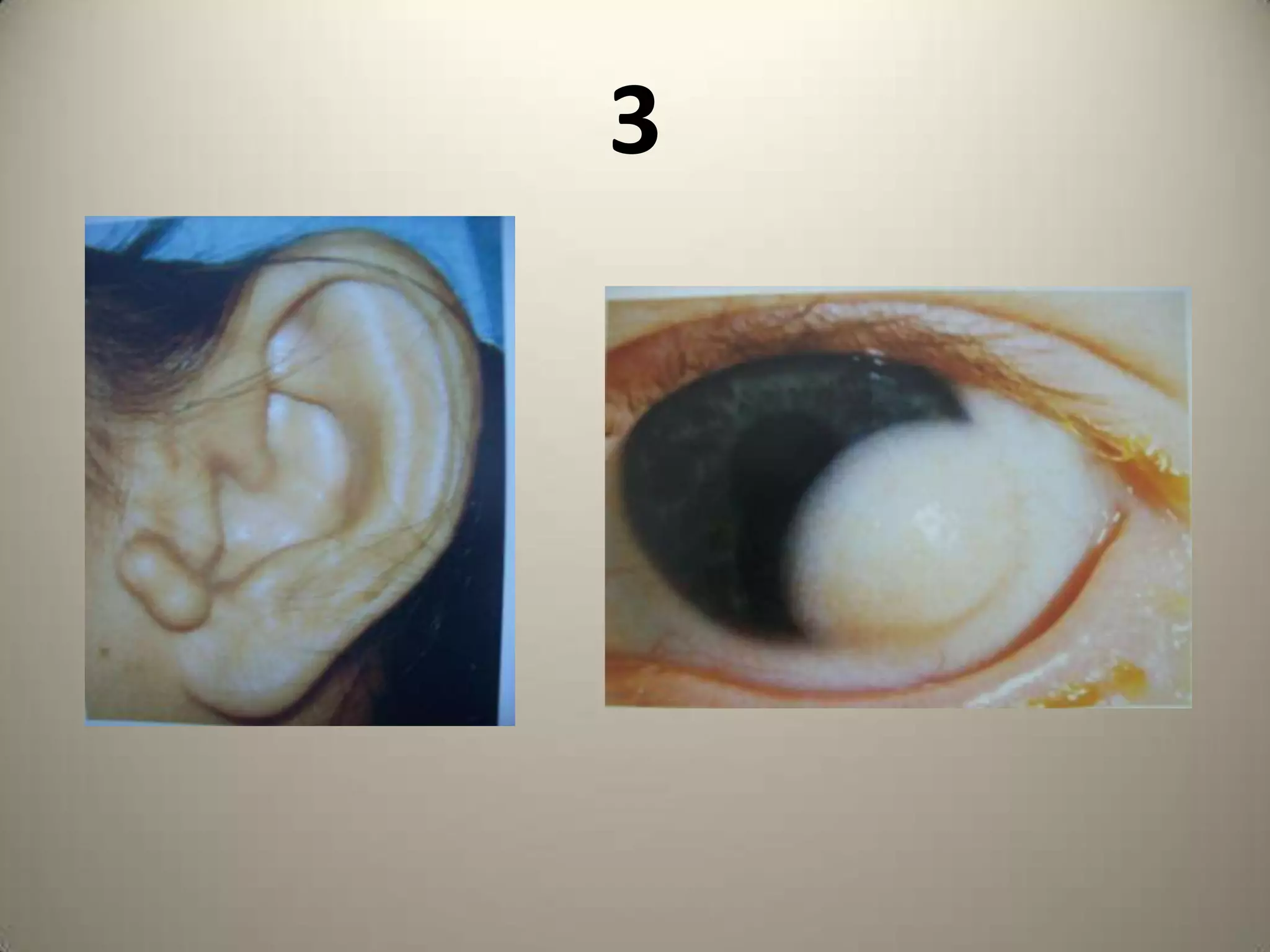Counts below 50 /cu mmHighly Active Antiretroviral Therapy     - 2NNRTI + 1 PI