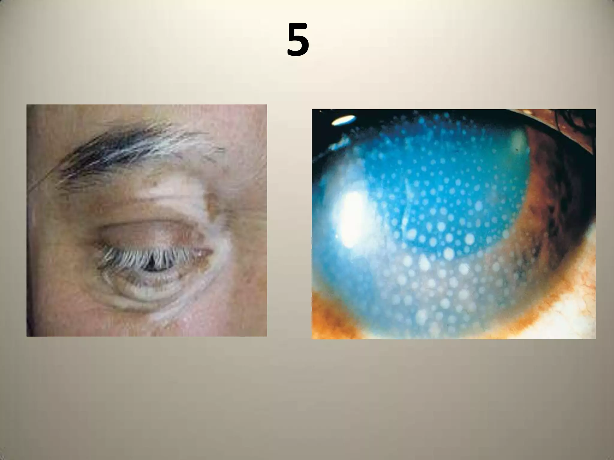 Vertebral – ScoliosisNormal tissue in an Abnormal location