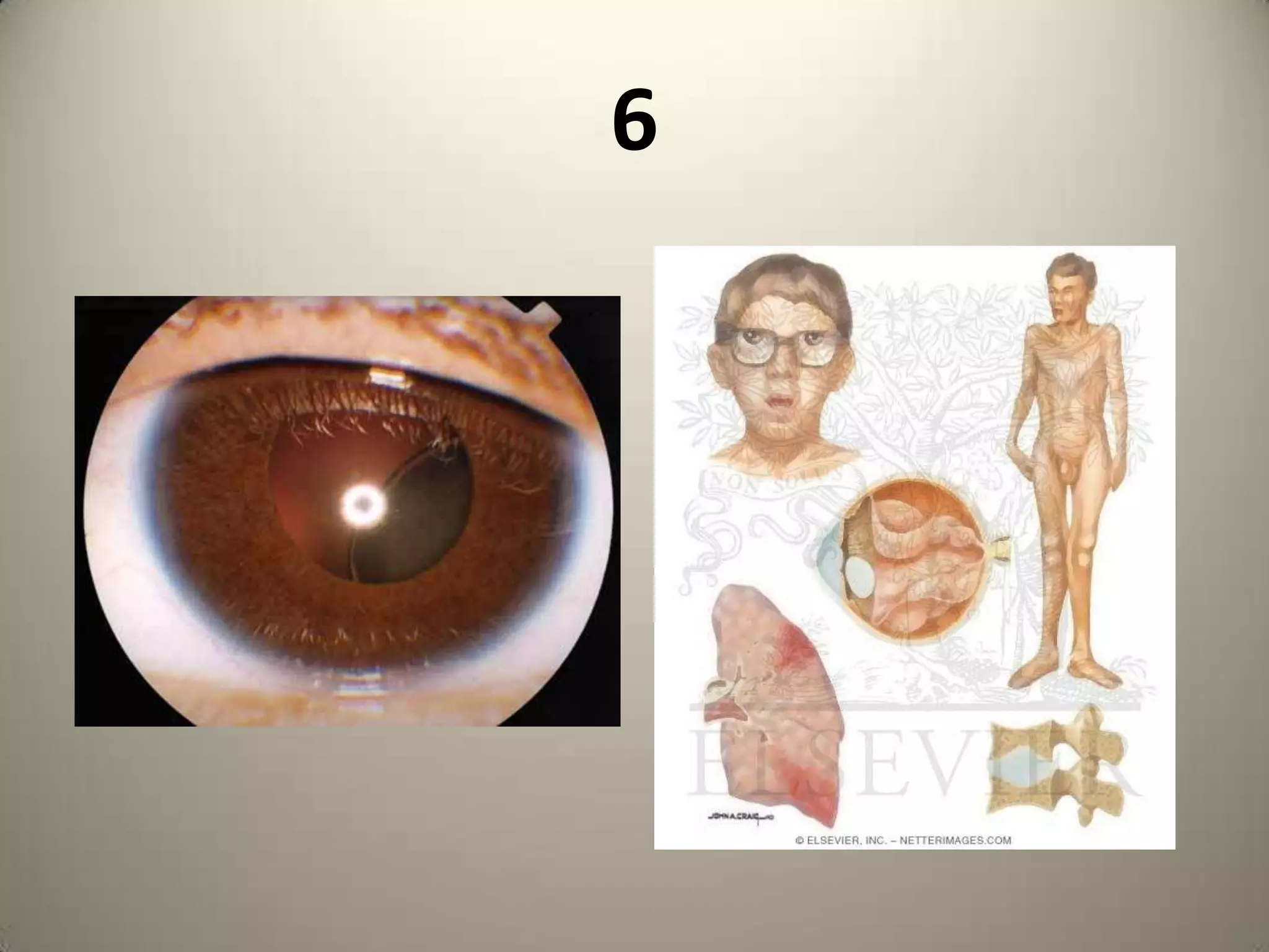 NSAIDS, SULPHA , PHENYTOINDRY EYE WITH SYMBLEPHARON