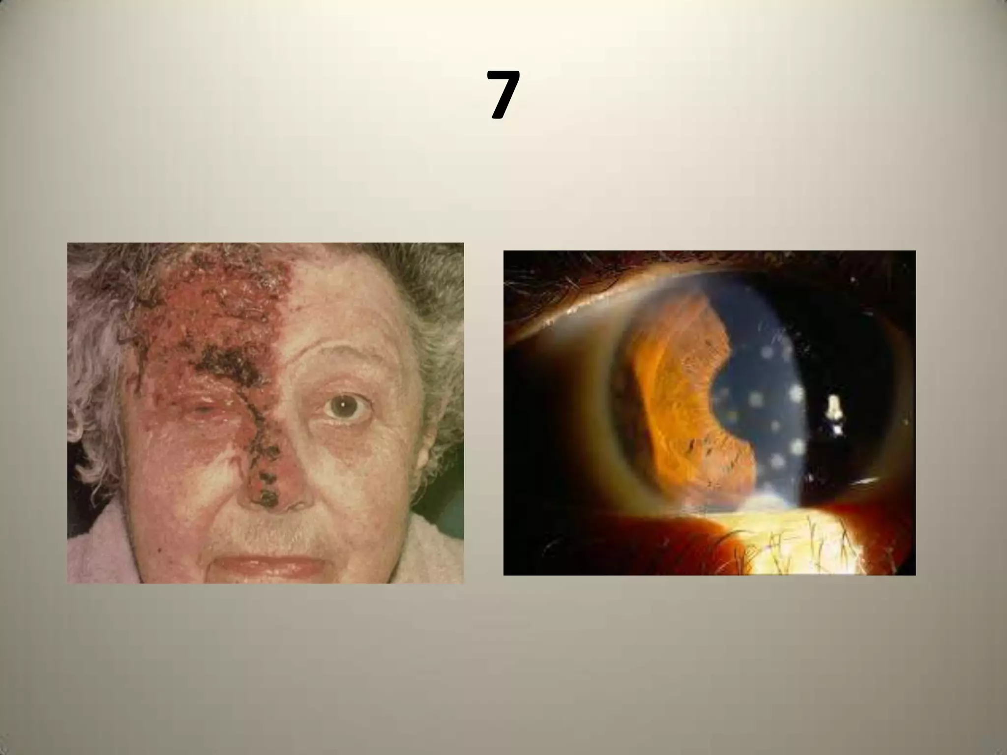 Mutton Fat KP’sNeurological features & Exudative Retinal Detachment