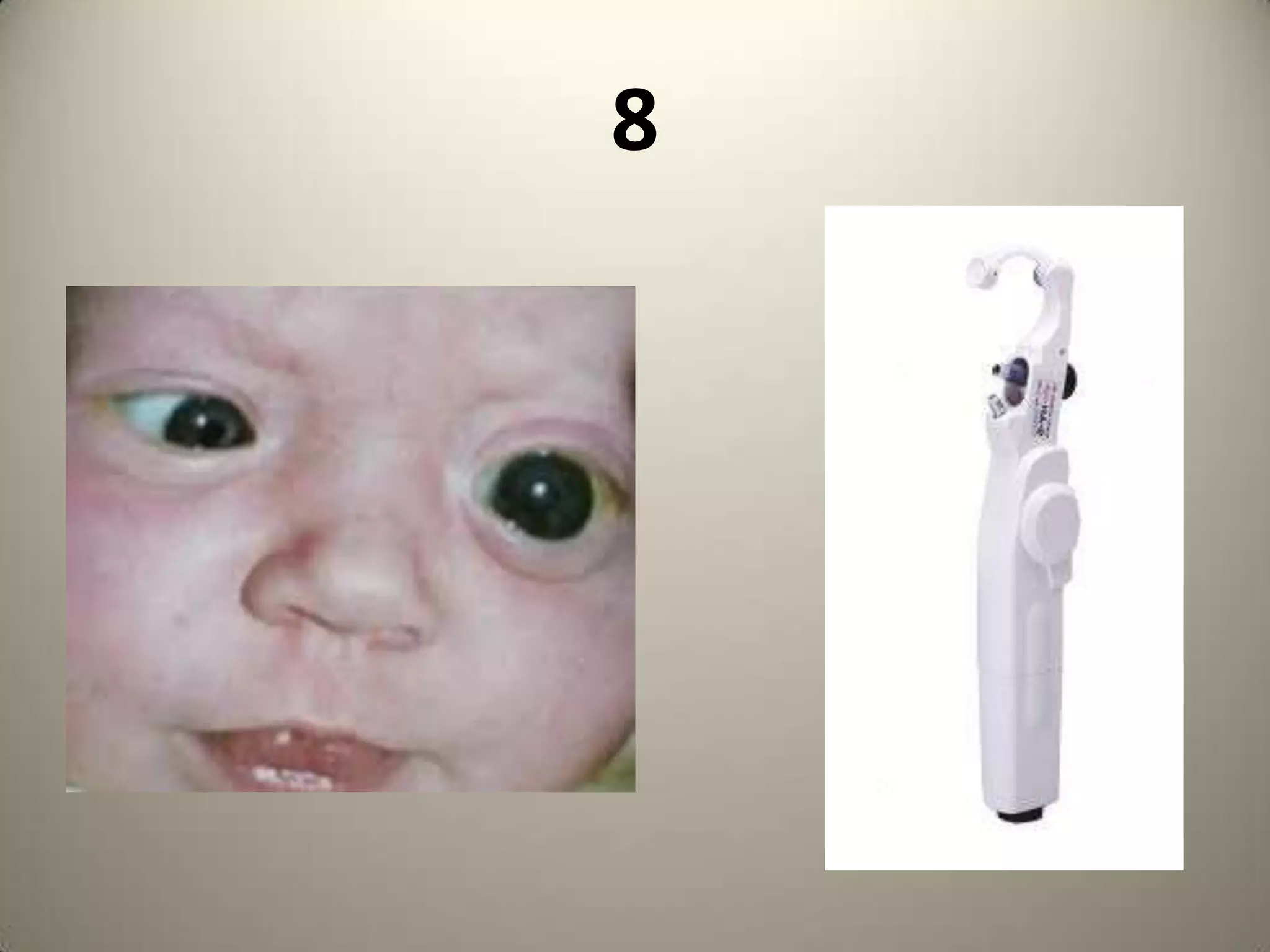 Inferonasal while in Marfan’s it is SuperotemporalCapsular Tension Ring used in the management of subluxated lenses