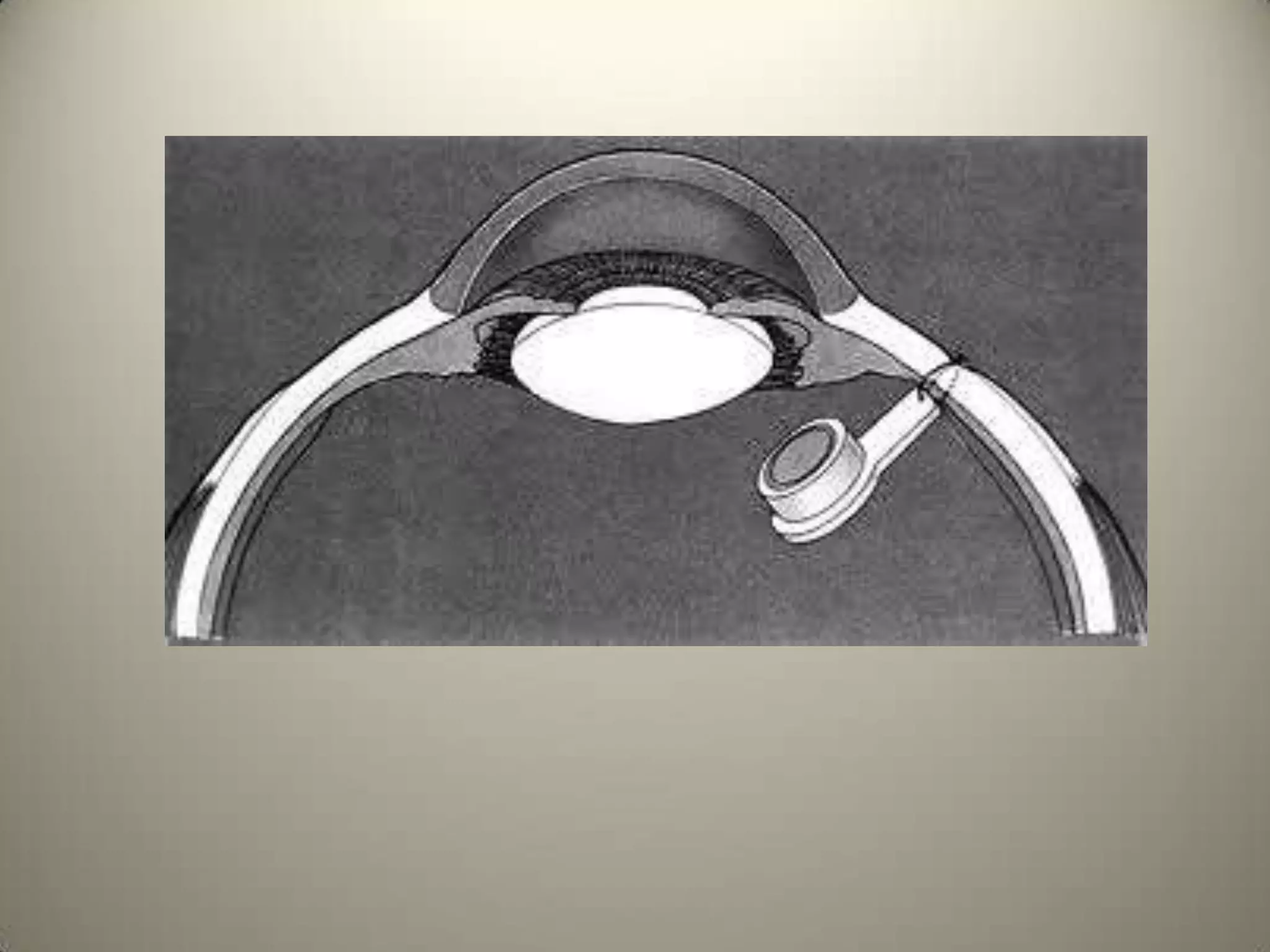 If the tip of the Nose is involved then Cornea is likely to  be involved as both are supplied by Nasociliary branch of Trigeminal.Immune reaction characterised by subepithelial deposits surrounded by a stromal haze.