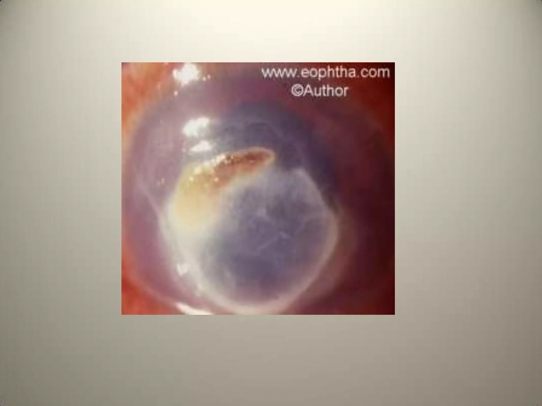 Why is it called buphthalmos ?What is the gene responsible ?What is the normal corneal diameter at birth? What is the average corneal dia in buphthalmos?