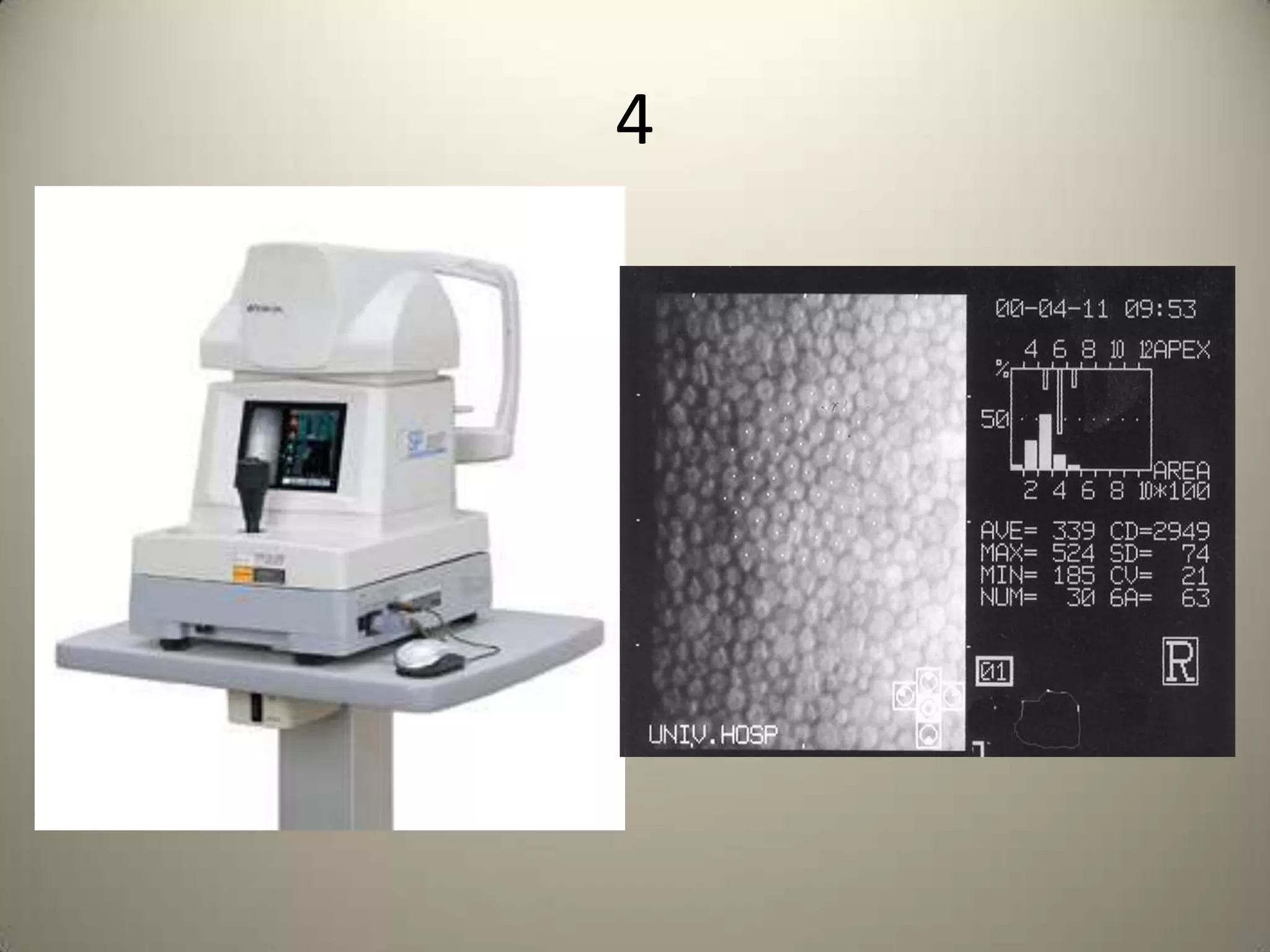 Humphrey field analyserIsolated paracentralscotoma