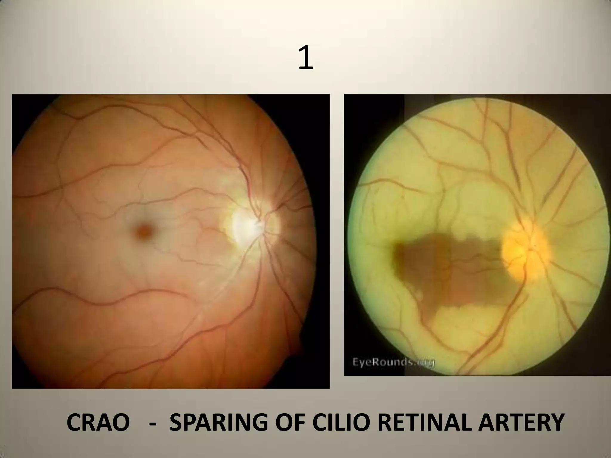 What is this instrument used for ?What is the count below which the there is a risk of endothelial decompensation?