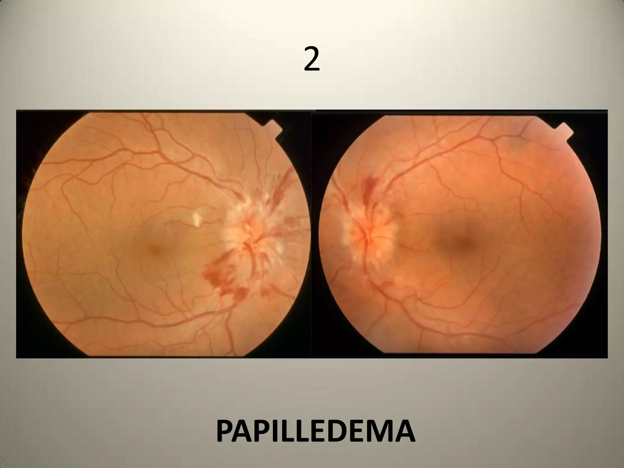 ROUND 7: RETINAIdentification of the RETINAL PATHOLOGY  10 pointsEach question carries 10 pointsTOTAL      20 POINTSOn passing 5 points for each