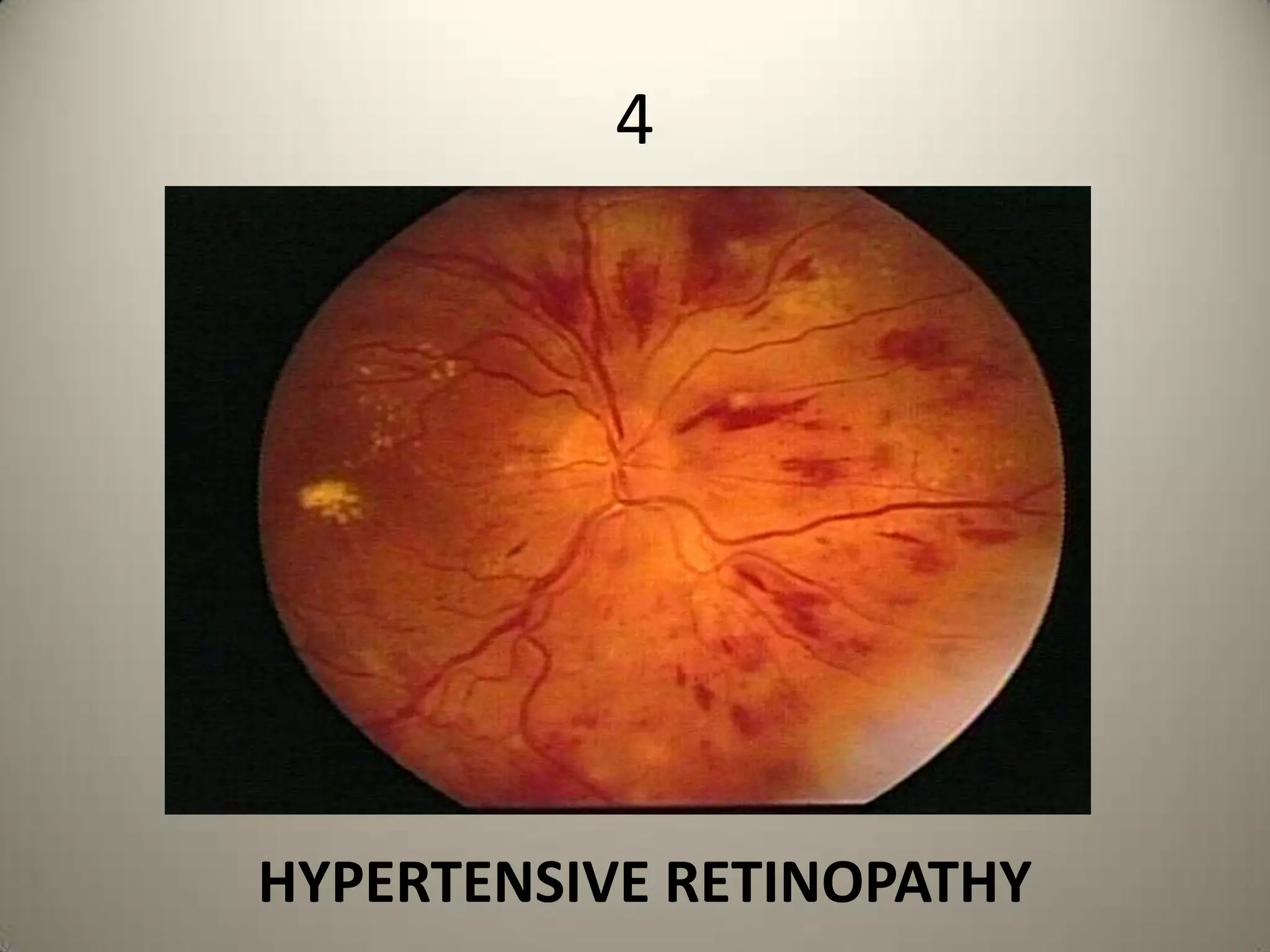 Ipsilateral Optic atrophy & ContralateralPapilledemaSeen in Olfactory groove Meningioma & Frontal lobe tumors