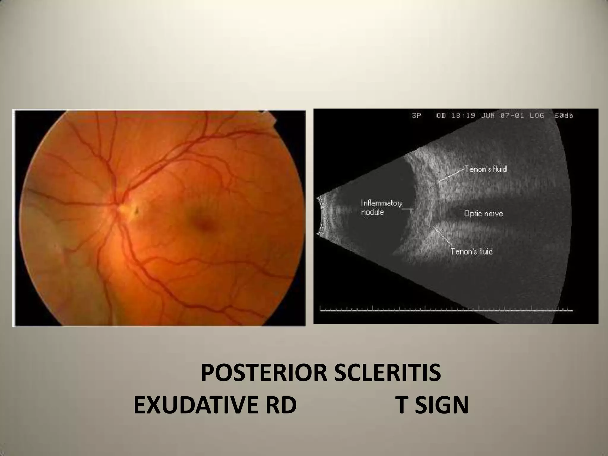    Normally there are 2 copies of Tumor Supressor Genes ,either mutation or deletion of BOTH GENES ALONE will lead to manifestation of RETINOBLASTOMA