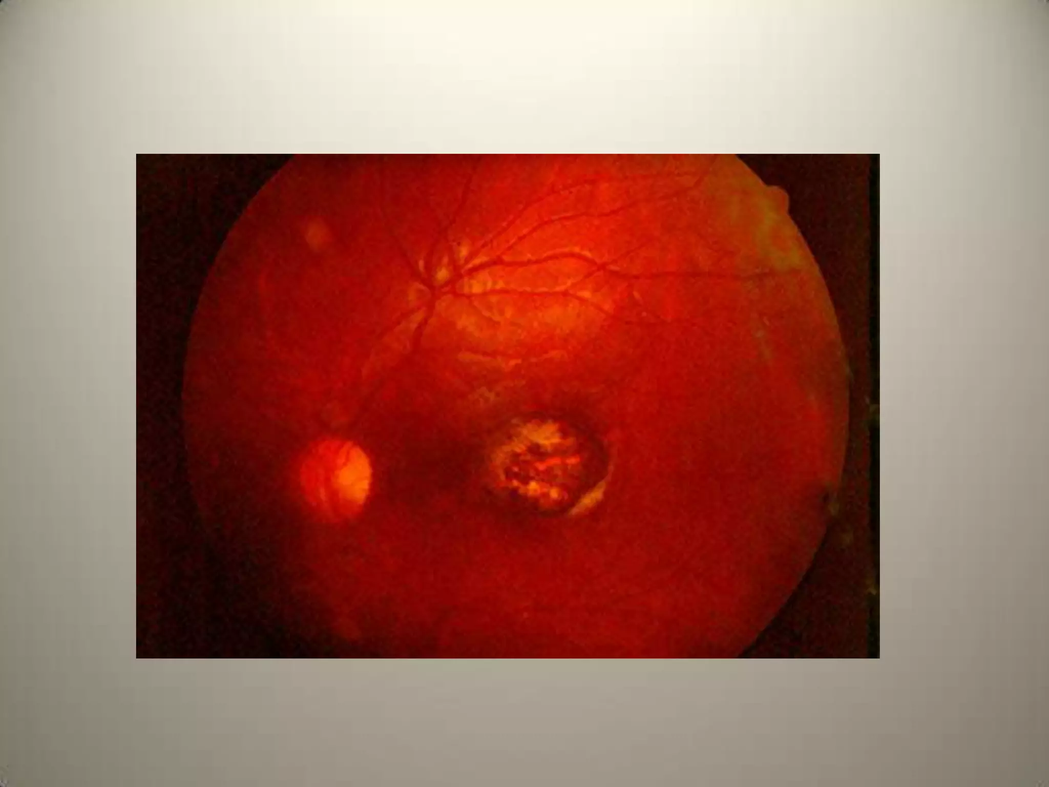 Elschnig’s spots are focal choroidal infarcts seen in Hypertensive RetinopathySiegrists streaks -In chronic hypertension choroidal arterioles are sclerosed & capillaries attenuated.
