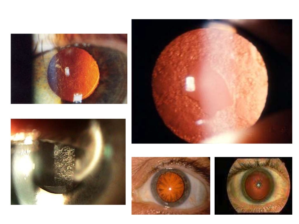 Ophthalmoscopy Review