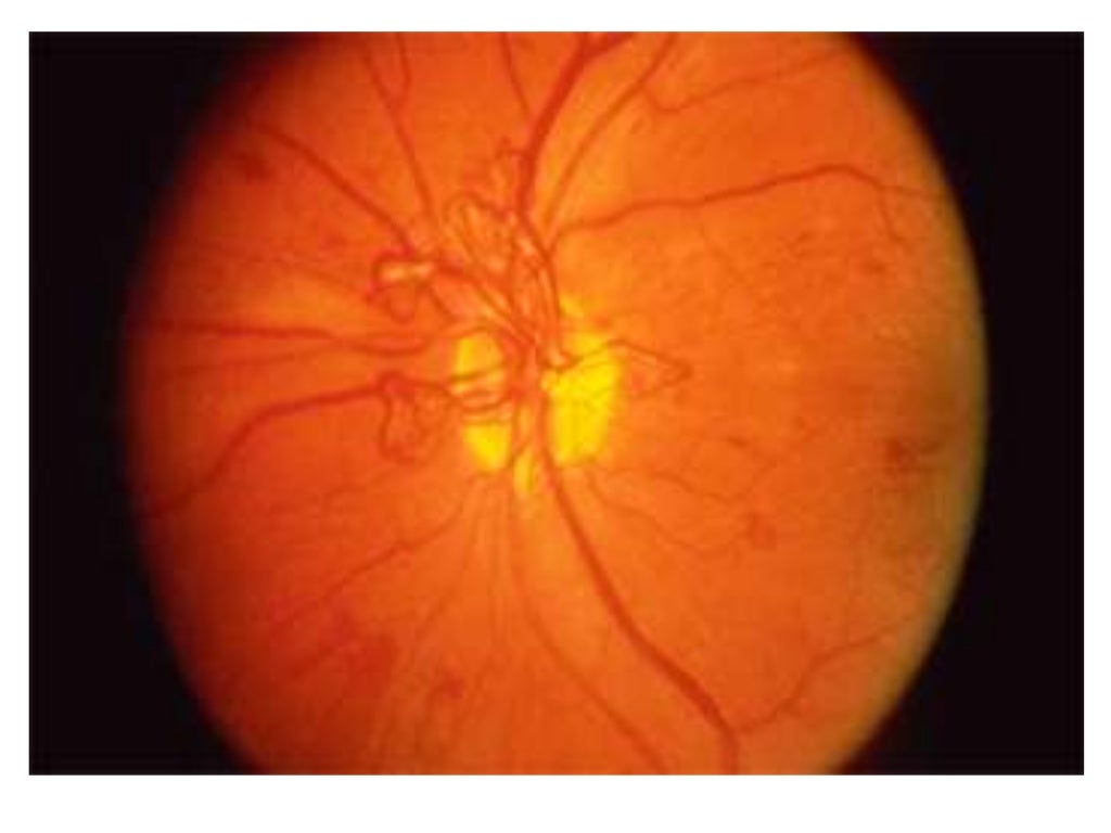 Ophthalmoscopy Review