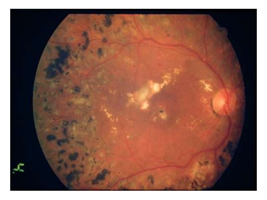 Ophthalmoscopy Review