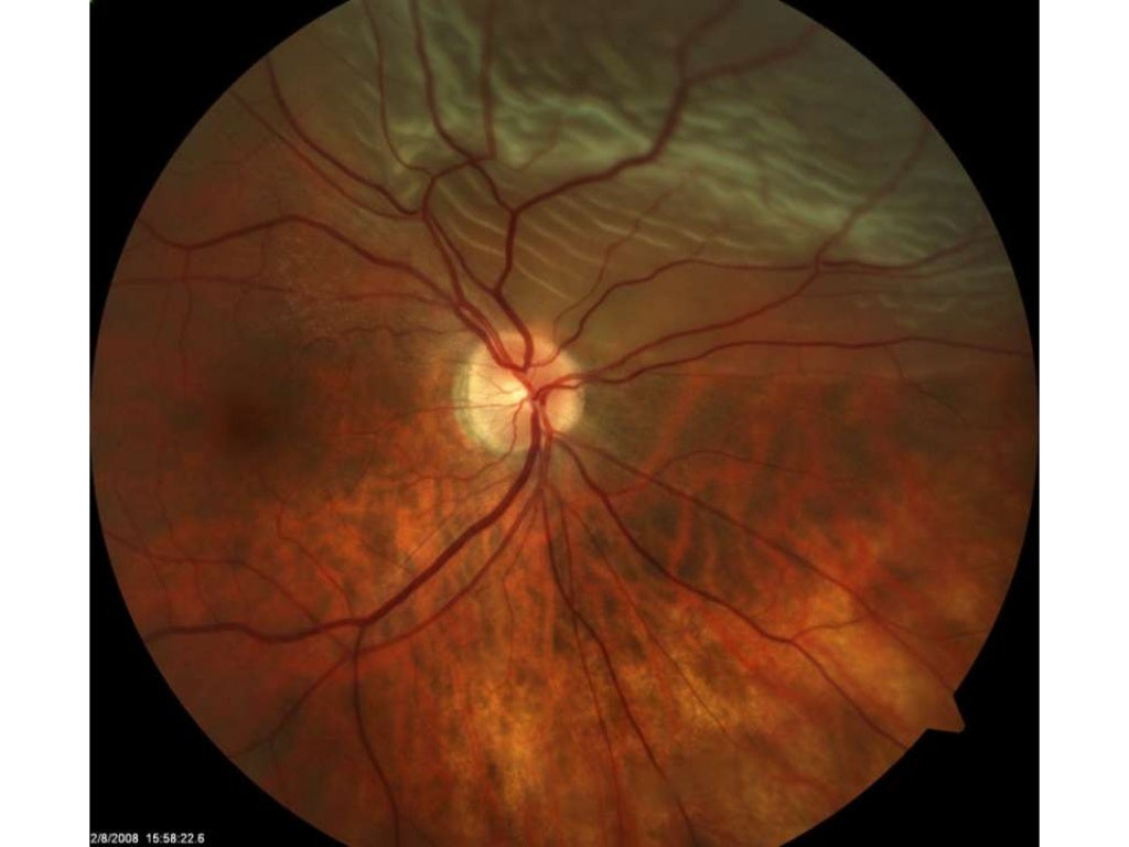 Ophthalmoscopy Review