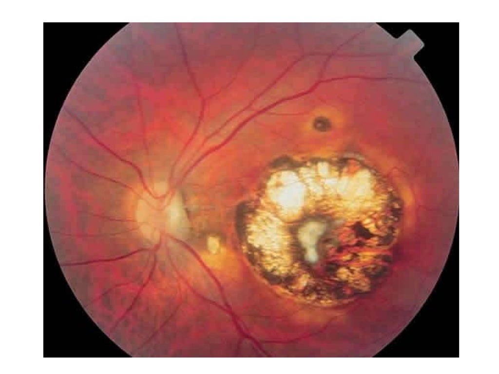 Ophthalmoscopy Review