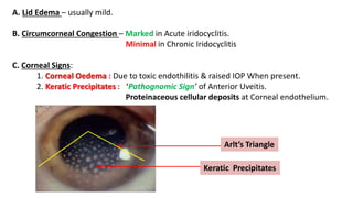 A. Lid Edema – usually mild.
B. Circumcorneal Congestion – Marked in Acute iridocyclitis.
Minimal in Chronic Iridocyclitis
C. Corneal Signs:
1. Corneal Oedema : Due to toxic endothilitis & raised IOP When present.
2. Keratic Precipitates : ‘Pathognomic Sign’ of Anterior Uveitis.
Proteinaceous cellular deposits at Corneal endothelium.
Arlt’s Triangle
Keratic Precipitates
 