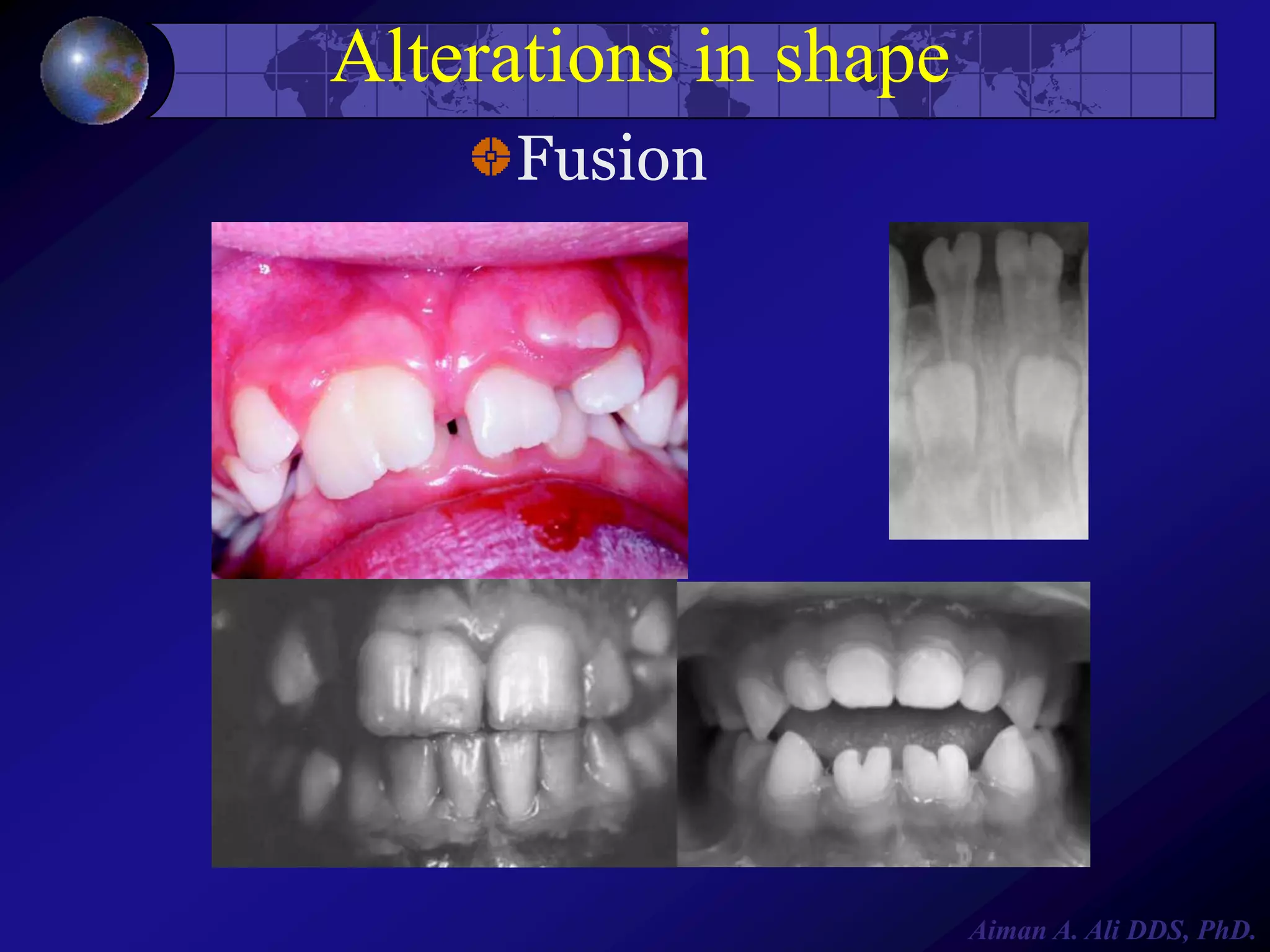 Alterations in shape
Fusion

Aiman A. Ali DDS, PhD.

 