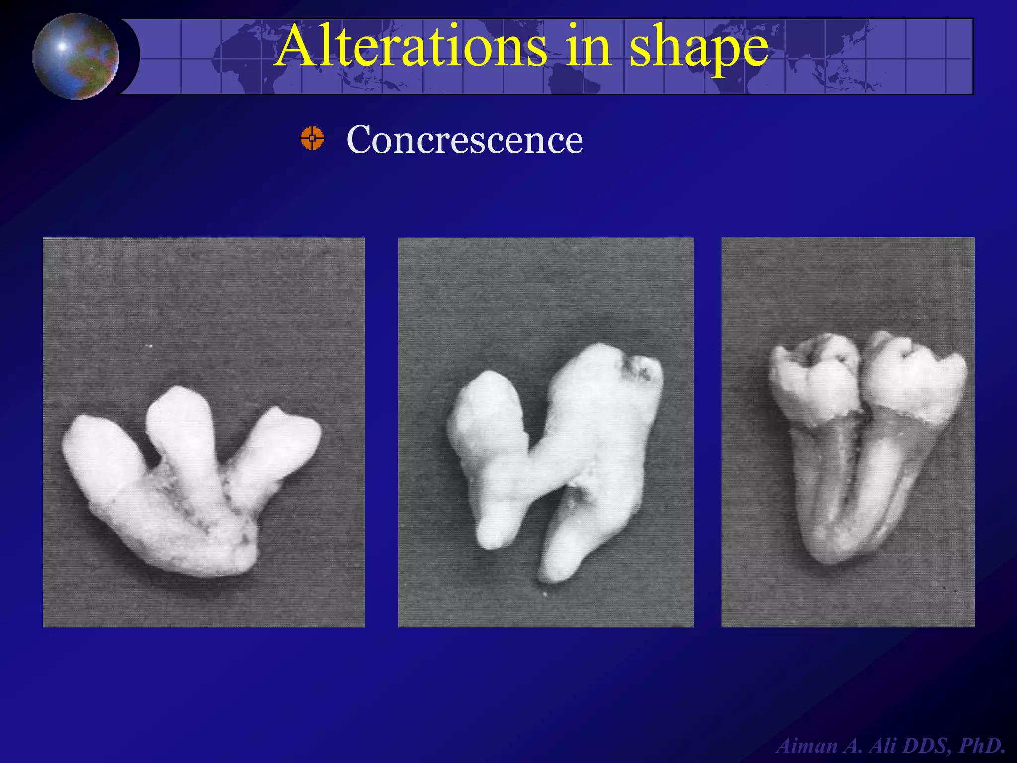 Alterations in shape
Concrescence

Aiman A. Ali DDS, PhD.

 