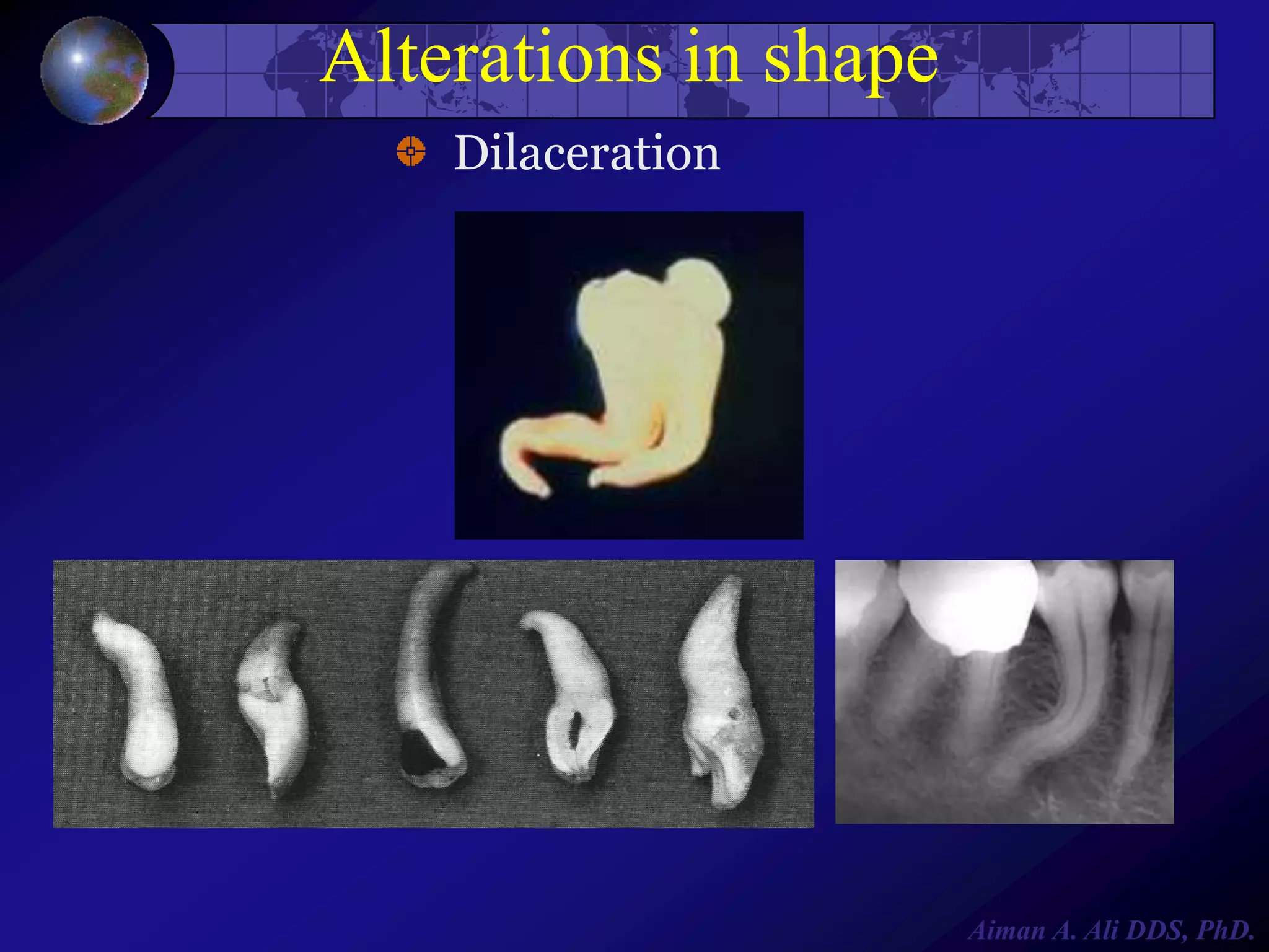 Alterations in shape
Dilaceration

Aiman A. Ali DDS, PhD.

 