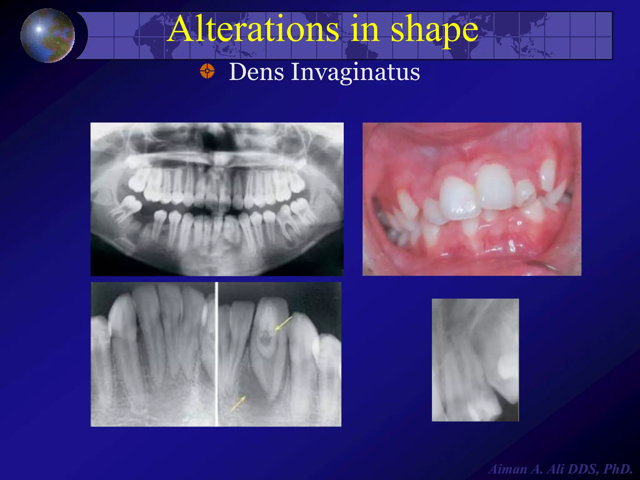 Alterations in shape
Dens Invaginatus

Aiman A. Ali DDS, PhD.

 