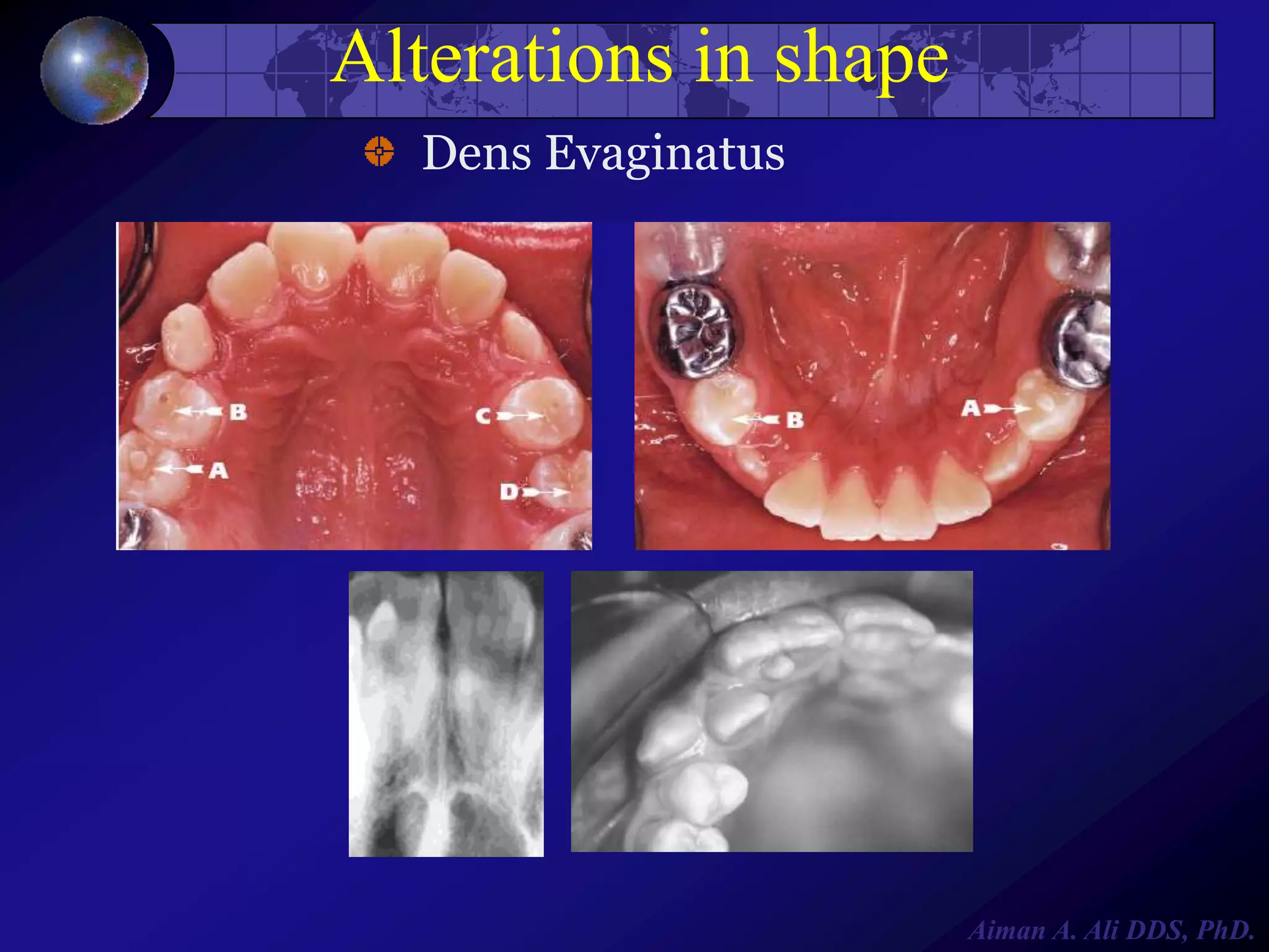 Alterations in shape
Dens Evaginatus

Aiman A. Ali DDS, PhD.

 