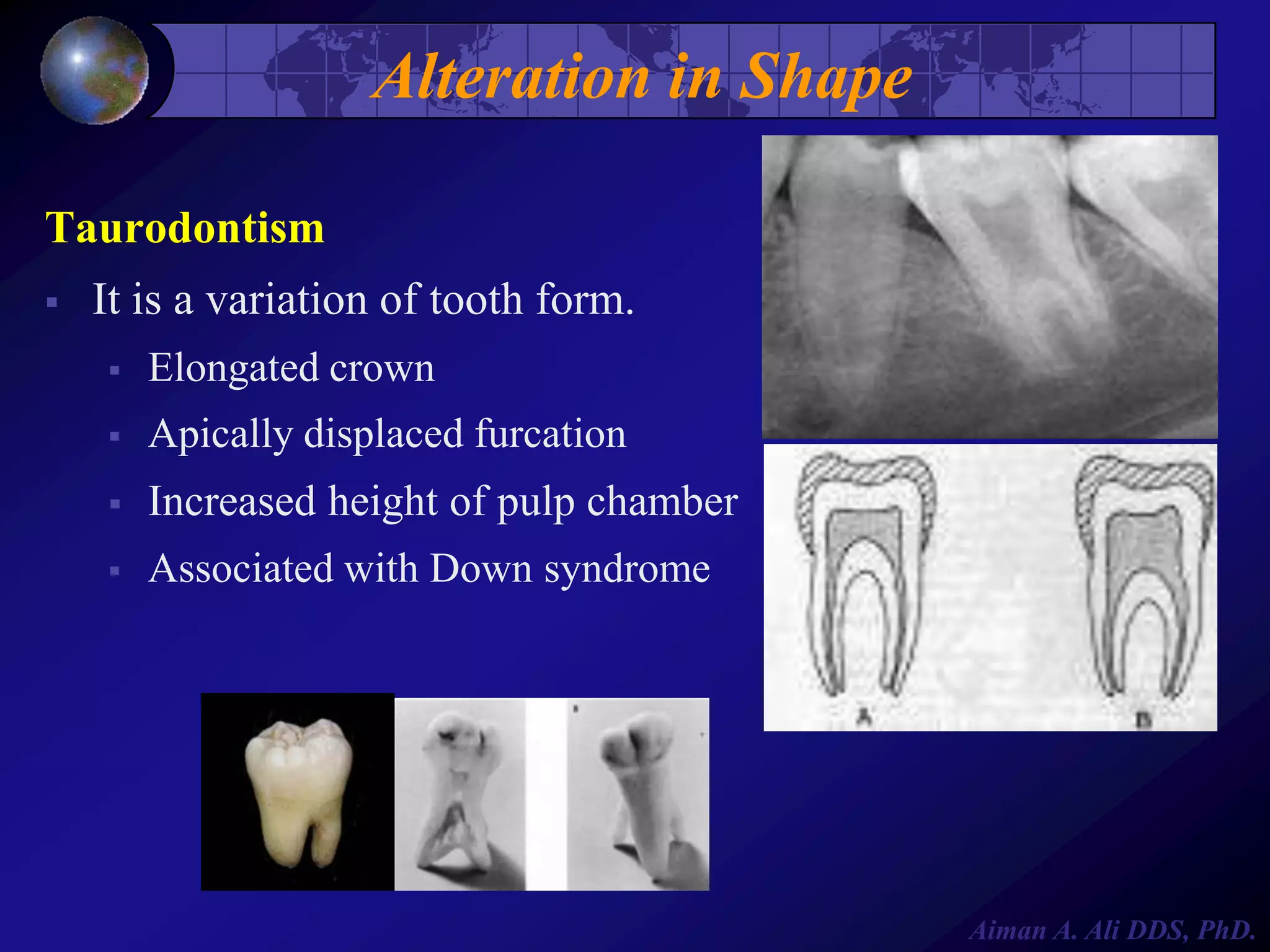 Alteration in Shape
Taurodontism


It is a variation of tooth form.


Elongated crown



Apically displaced furcation



Increased height of pulp chamber



Associated with Down syndrome

Aiman A. Ali DDS, PhD.

 