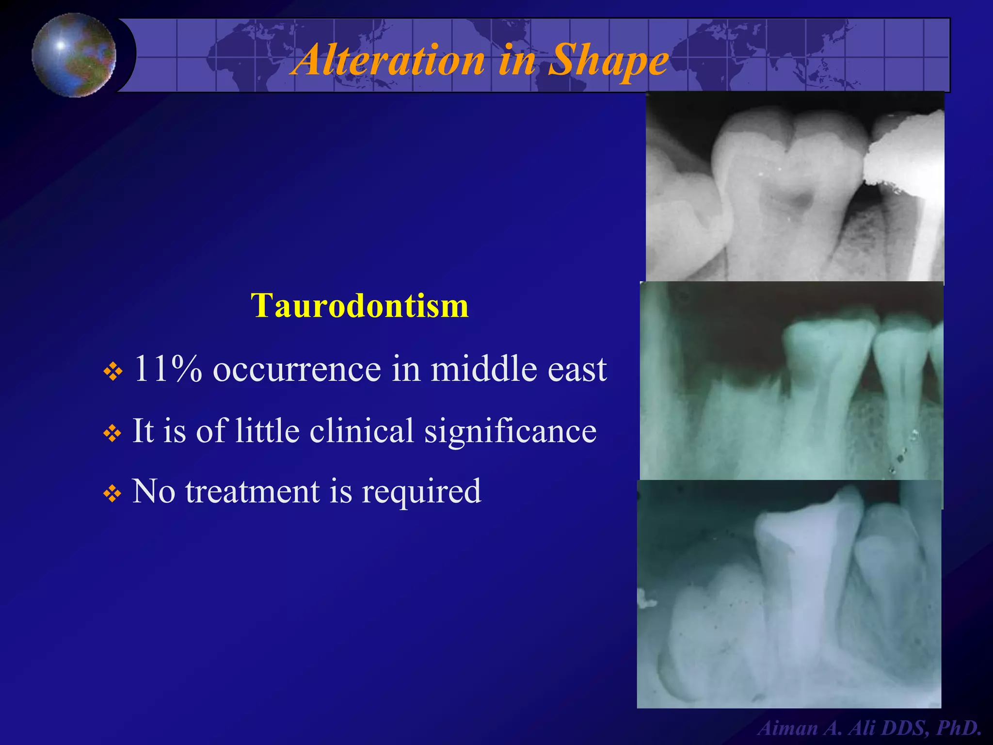 Alteration in Shape

Taurodontism
 11%

occurrence in middle east



It is of little clinical significance



No treatment is required

Aiman A. Ali DDS, PhD.

 