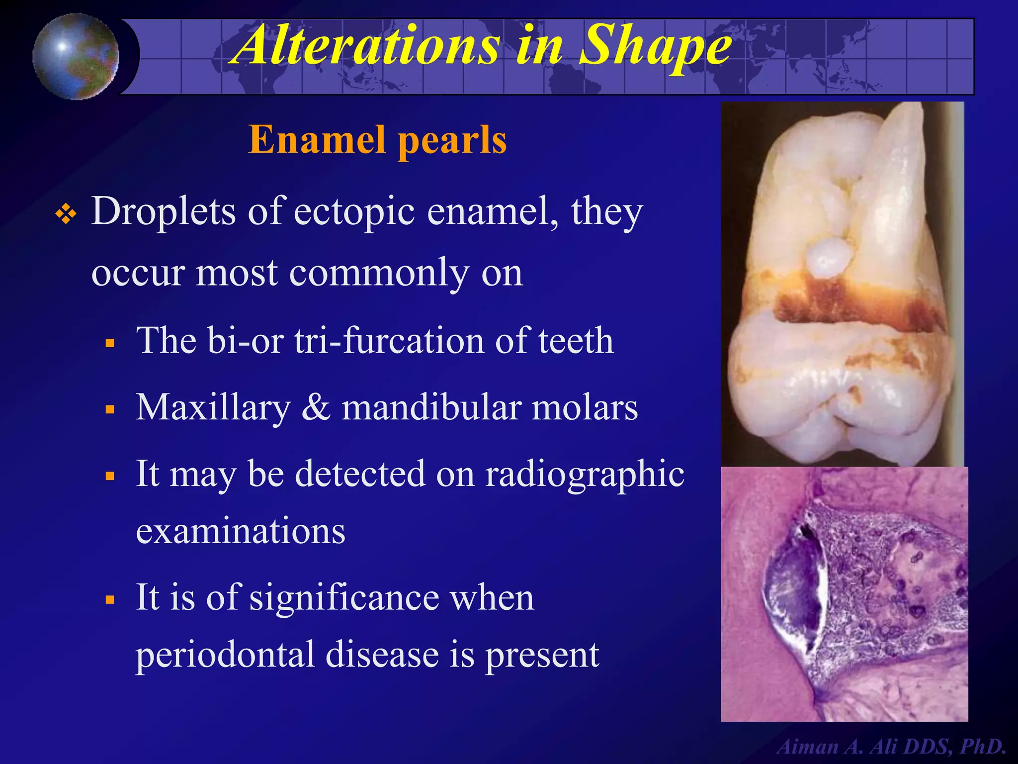 Alterations in Shape
Enamel pearls


Droplets of ectopic enamel, they
occur most commonly on


The bi-or tri-furcation of teeth



Maxillary & mandibular molars



It may be detected on radiographic
examinations



It is of significance when
periodontal disease is present
Aiman A. Ali DDS, PhD.

 