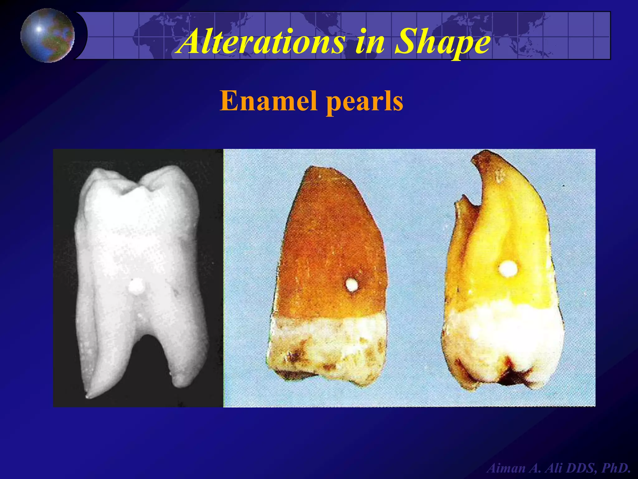Alterations in Shape
Enamel pearls

Aiman A. Ali DDS, PhD.

 