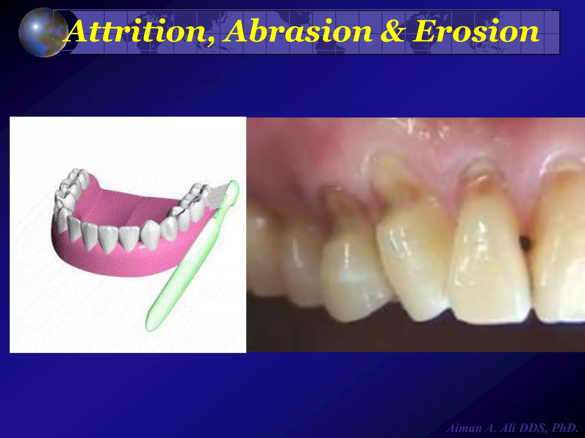 Attrition, Abrasion & Erosion

Aiman A. Ali DDS, PhD.

 