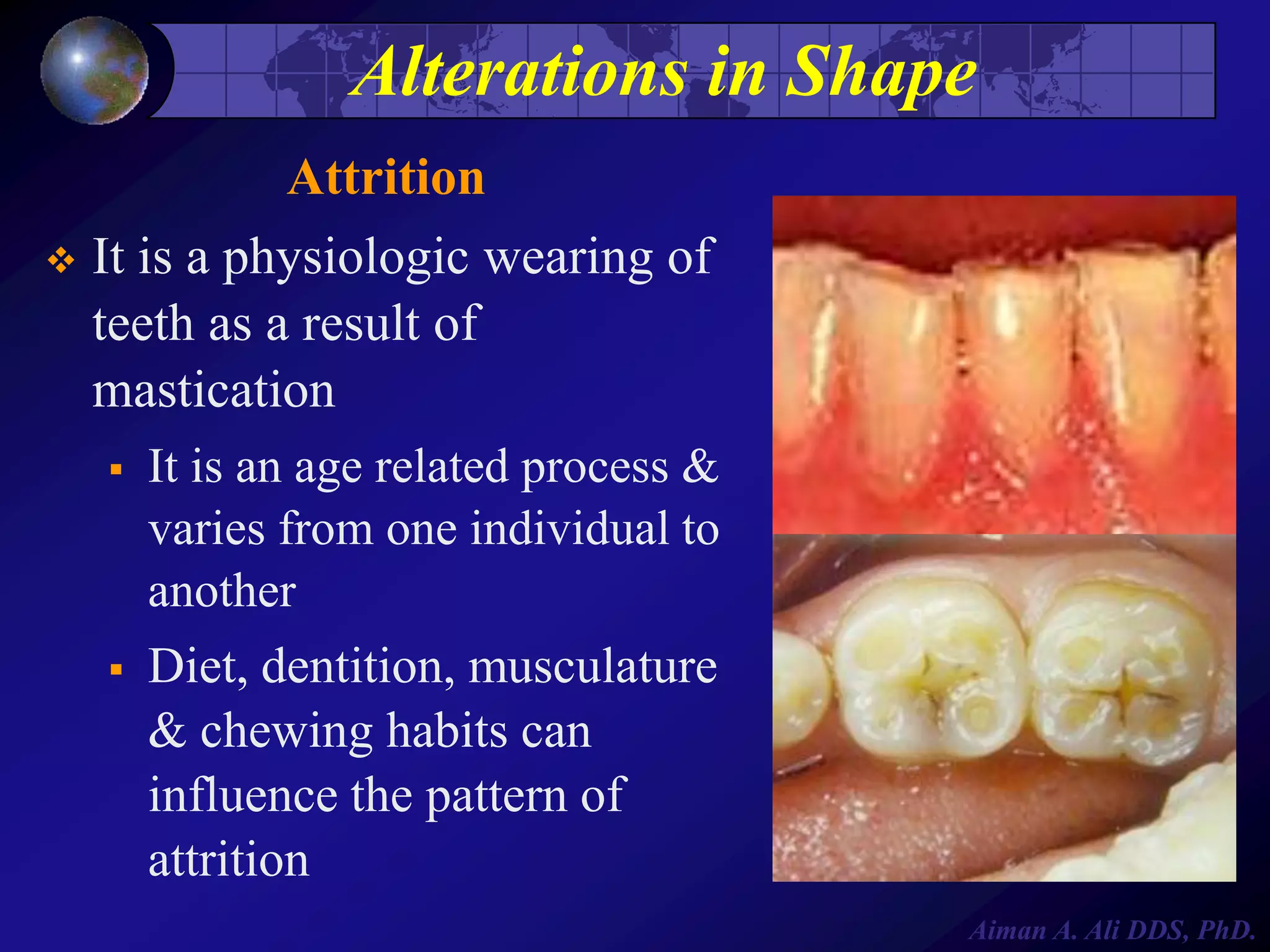 Alterations in Shape
Attrition
 It is a physiologic wearing of
teeth as a result of
mastication


It is an age related process &
varies from one individual to
another



Diet, dentition, musculature
& chewing habits can
influence the pattern of
attrition
Aiman A. Ali DDS, PhD.

 