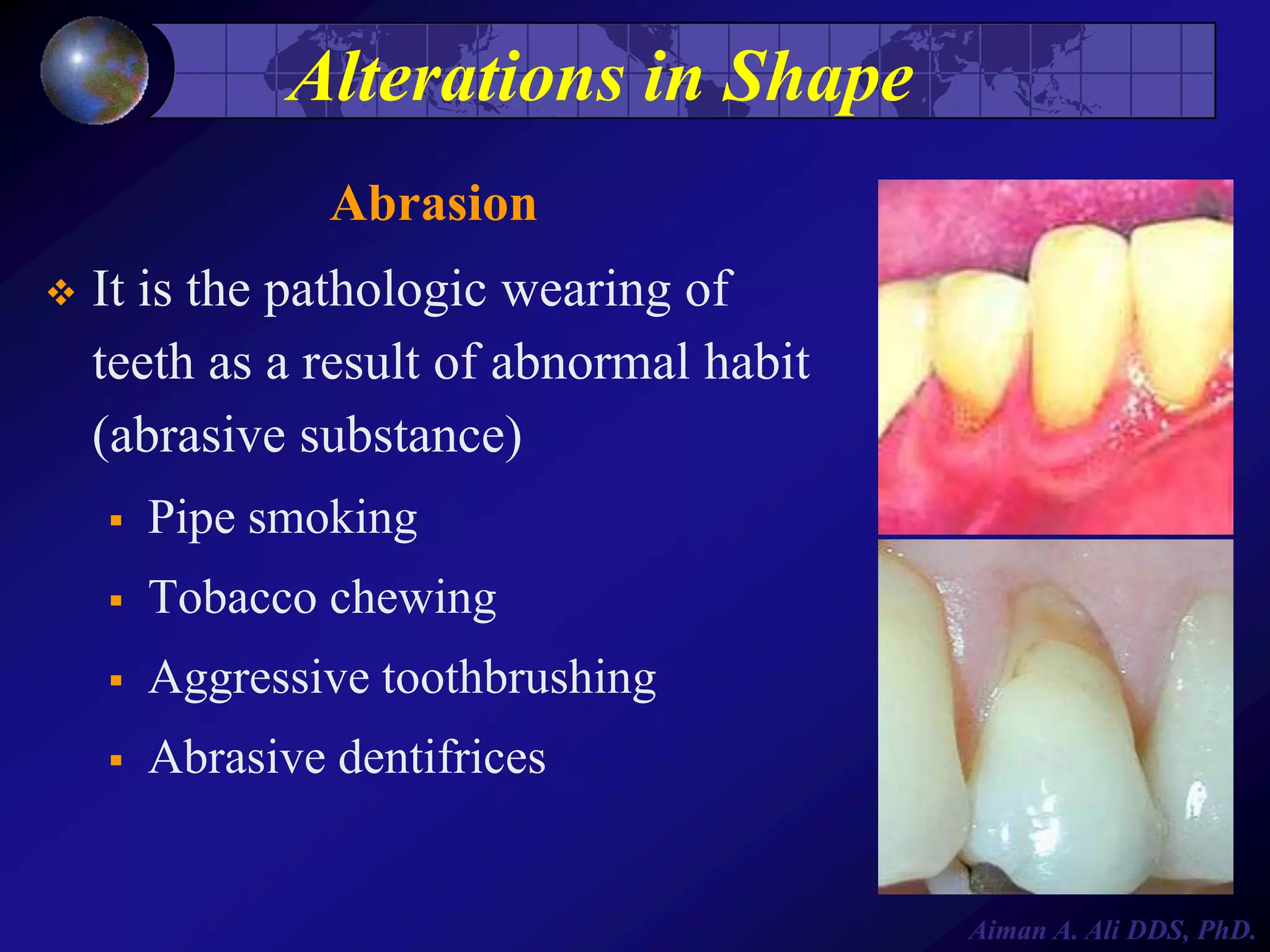 Alterations in Shape
Abrasion


It is the pathologic wearing of
teeth as a result of abnormal habit
(abrasive substance)


Pipe smoking



Tobacco chewing



Aggressive toothbrushing



Abrasive dentifrices

Aiman A. Ali DDS, PhD.

 
