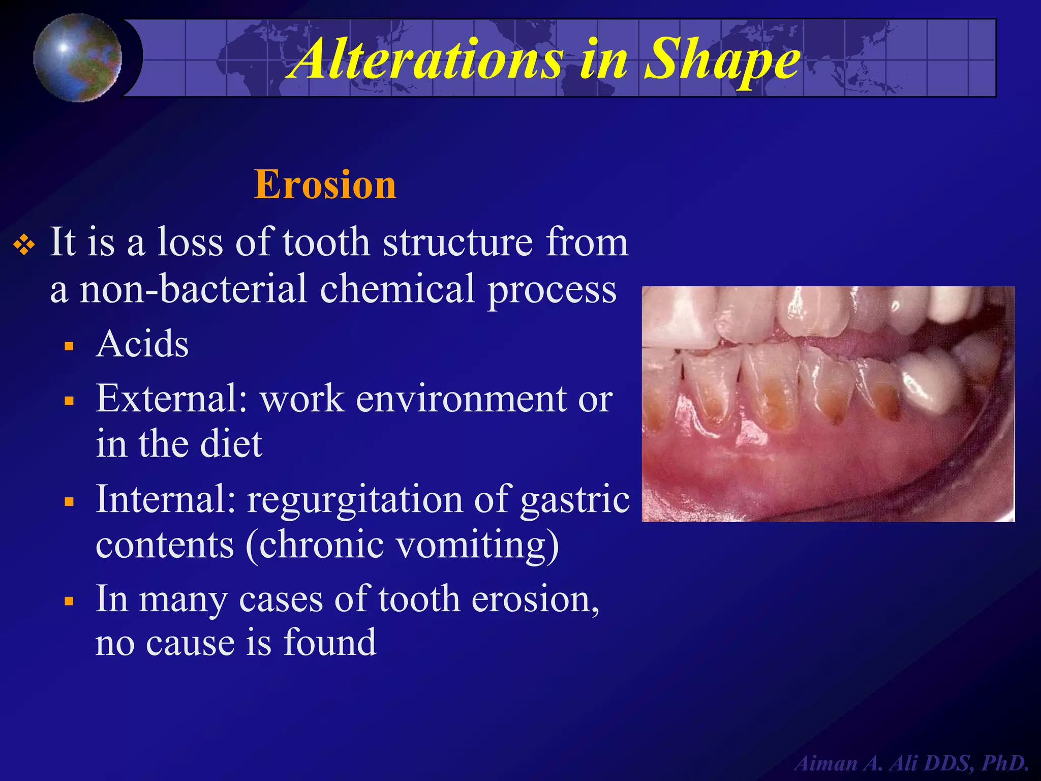 Alterations in Shape
Erosion
 It is a loss of tooth structure from
a non-bacterial chemical process






Acids
External: work environment or
in the diet
Internal: regurgitation of gastric
contents (chronic vomiting)
In many cases of tooth erosion,
no cause is found
Aiman A. Ali DDS, PhD.

 