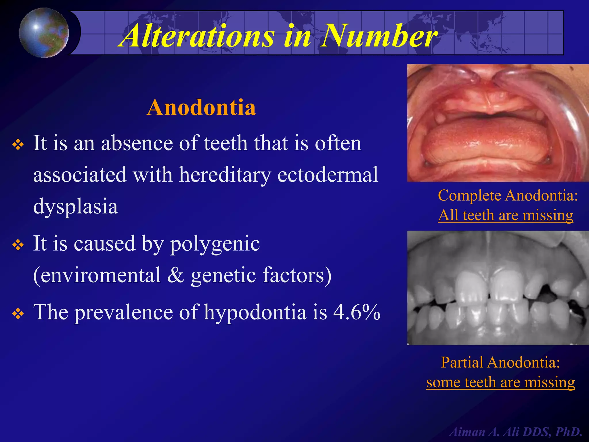 Alterations in Number
Anodontia


It is an absence of teeth that is often
associated with hereditary ectodermal
dysplasia



It is caused by polygenic
(enviromental & genetic factors)



Complete Anodontia:
All teeth are missing

The prevalence of hypodontia is 4.6%
Partial Anodontia:
some teeth are missing
Aiman A. Ali DDS, PhD.

 