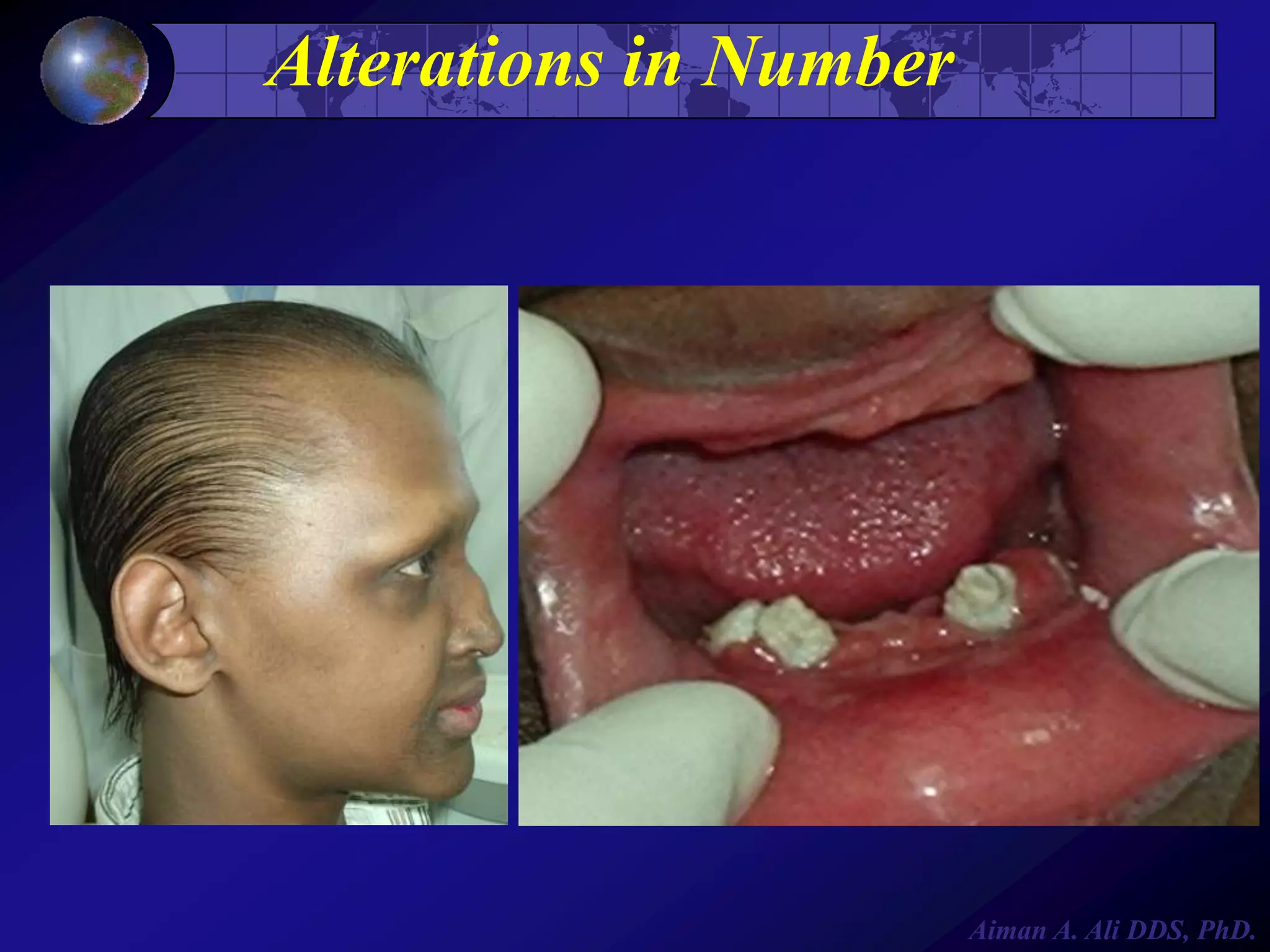 Alterations in Number

Aiman A. Ali DDS, PhD.

 