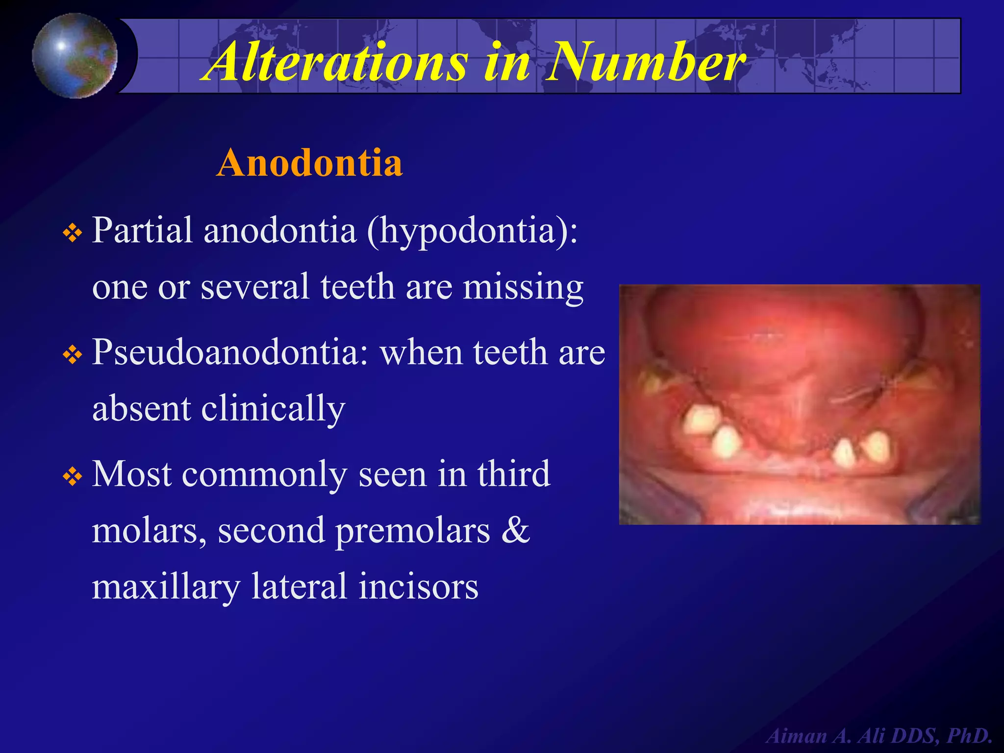Alterations in Number
Anodontia
 Partial

anodontia (hypodontia):
one or several teeth are missing

 Pseudoanodontia:

when teeth are

absent clinically
 Most

commonly seen in third
molars, second premolars &
maxillary lateral incisors

Aiman A. Ali DDS, PhD.

 