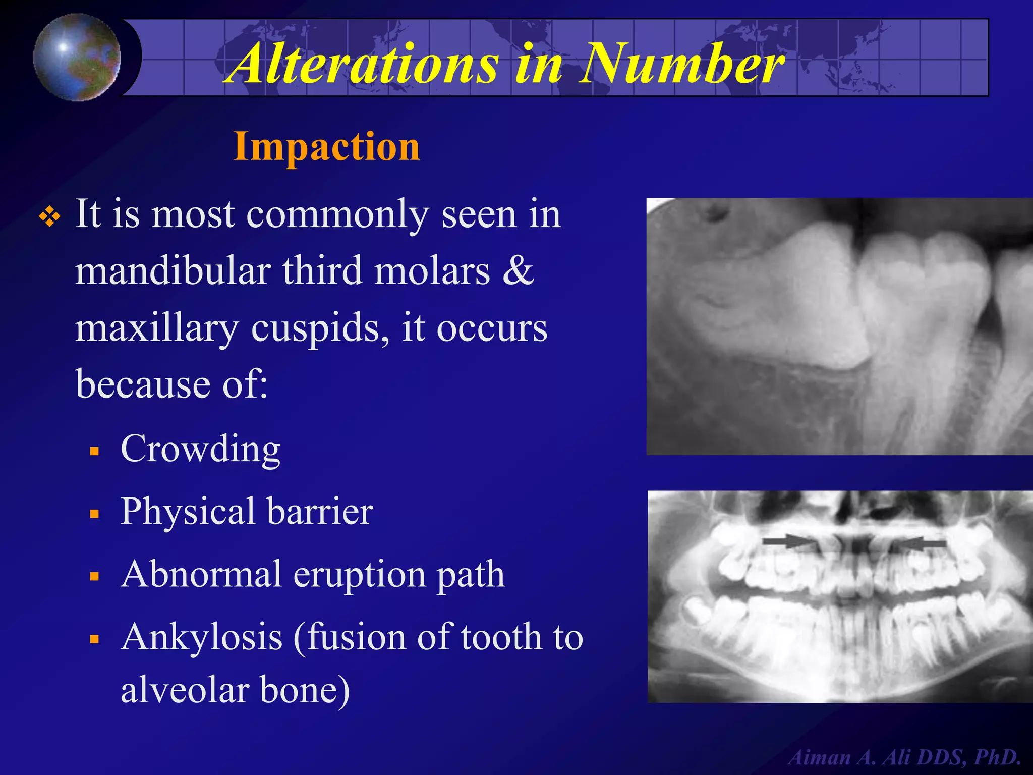 Alterations in Number
Impaction


It is most commonly seen in
mandibular third molars &
maxillary cuspids, it occurs
because of:


Crowding



Physical barrier



Abnormal eruption path



Ankylosis (fusion of tooth to
alveolar bone)
Aiman A. Ali DDS, PhD.

 