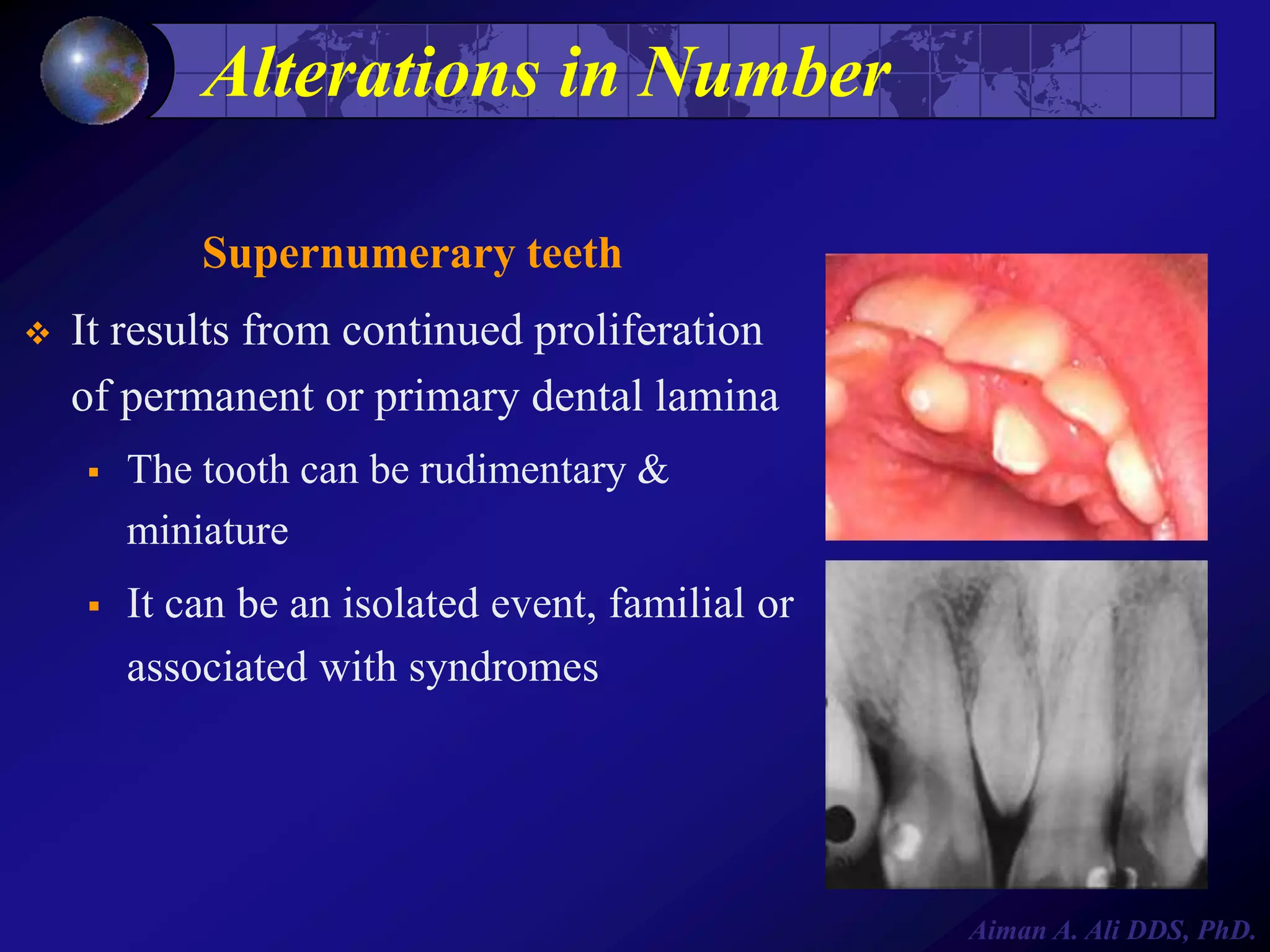 Alterations in Number
Supernumerary teeth


It results from continued proliferation
of permanent or primary dental lamina


The tooth can be rudimentary &
miniature



It can be an isolated event, familial or
associated with syndromes

Aiman A. Ali DDS, PhD.

 