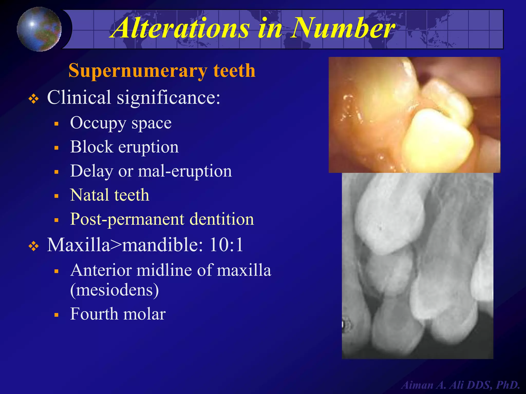 Alterations in Number


Supernumerary teeth
Clinical significance:








Occupy space
Block eruption
Delay or mal-eruption
Natal teeth
Post-permanent dentition

Maxilla>mandible: 10:1




Anterior midline of maxilla
(mesiodens)
Fourth molar

Aiman A. Ali DDS, PhD.

 