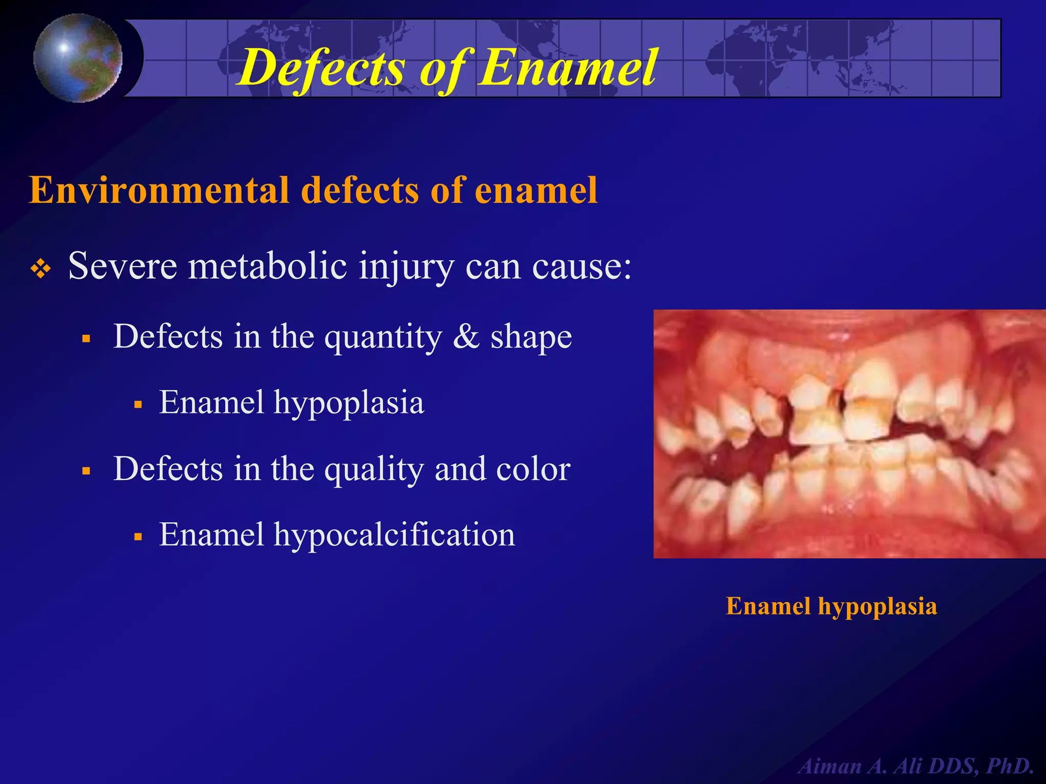 Defects of Enamel
Environmental defects of enamel


Severe metabolic injury can cause:


Defects in the quantity & shape




Enamel hypoplasia

Defects in the quality and color


Enamel hypocalcification
Enamel hypoplasia

Aiman A. Ali DDS, PhD.

 