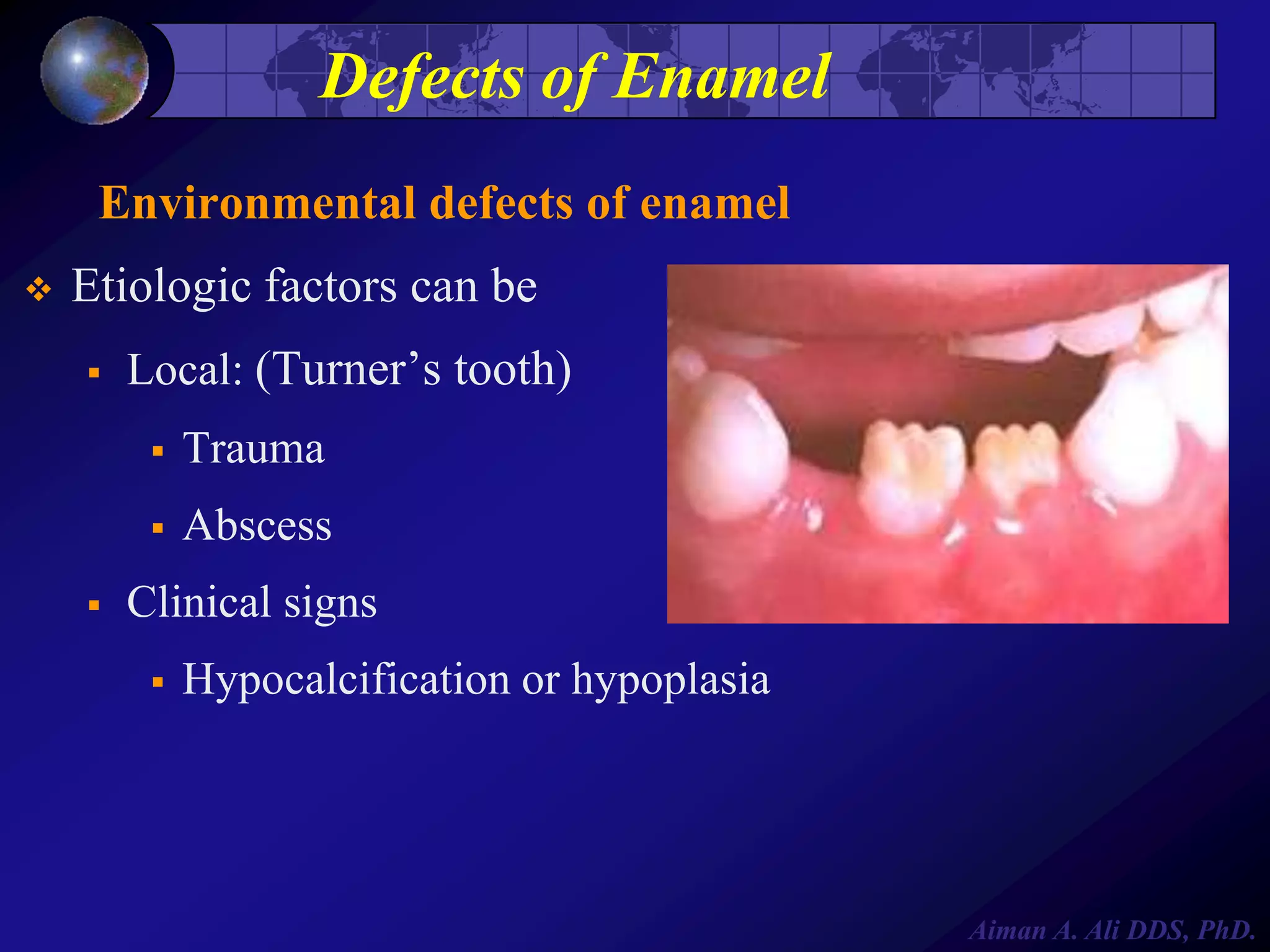 Defects of Enamel
Environmental defects of enamel


Etiologic factors can be


Local: (Turner’s tooth)





Trauma
Abscess

Clinical signs


Hypocalcification or hypoplasia

Aiman A. Ali DDS, PhD.

 