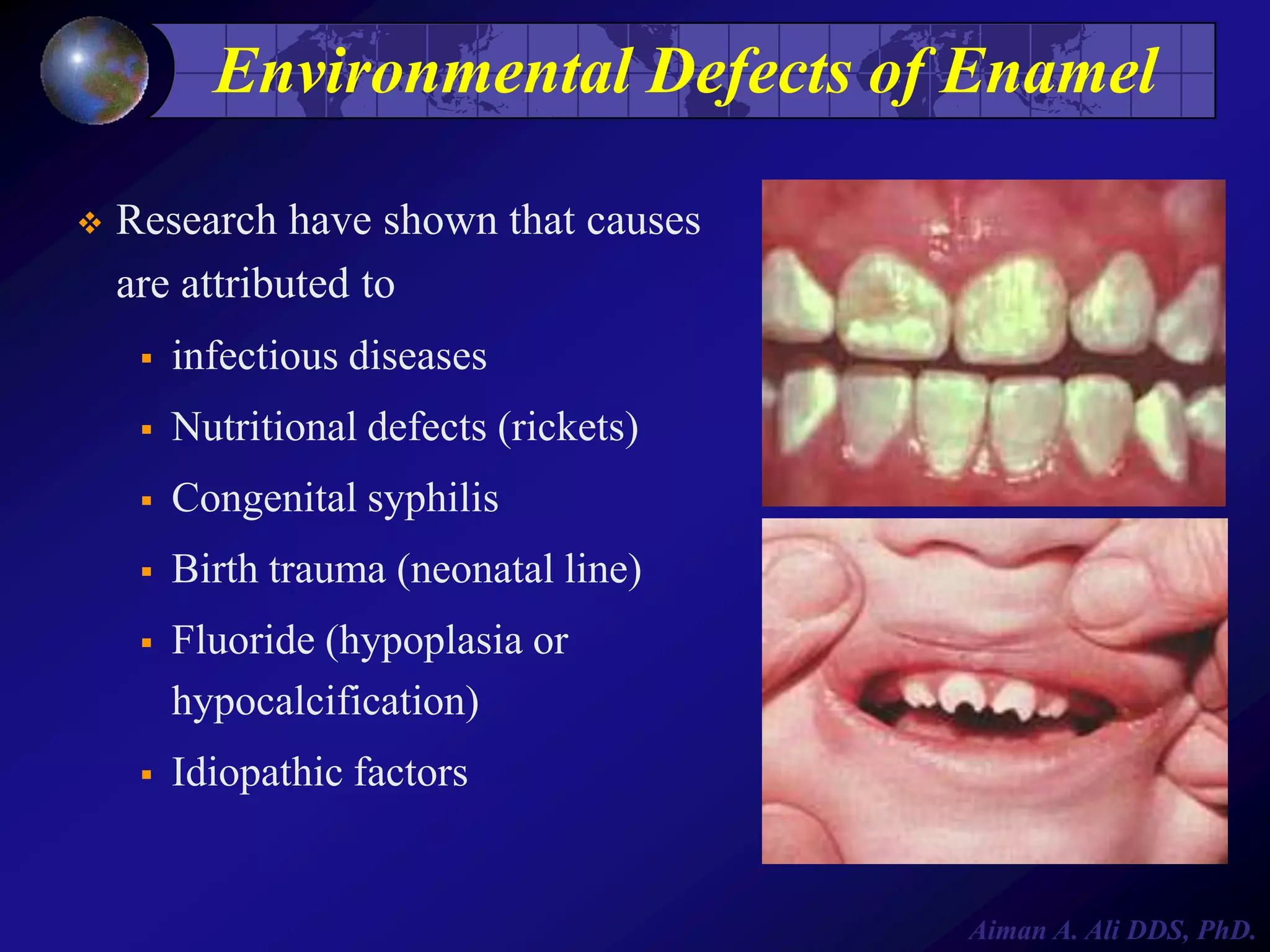 Environmental Defects of Enamel


Research have shown that causes
are attributed to


infectious diseases



Nutritional defects (rickets)



Congenital syphilis



Birth trauma (neonatal line)



Fluoride (hypoplasia or
hypocalcification)



Idiopathic factors

Aiman A. Ali DDS, PhD.

 