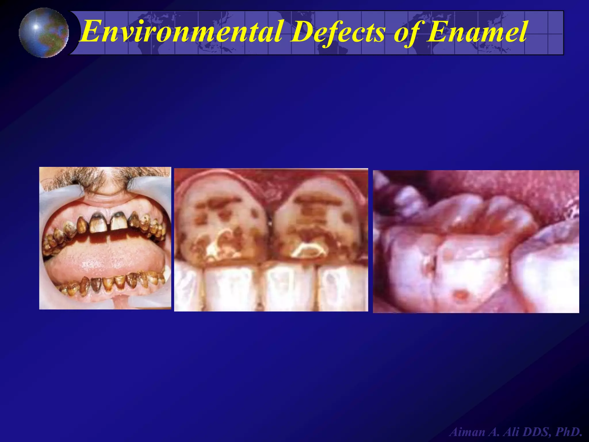 Environmental Defects of Enamel

Aiman A. Ali DDS, PhD.

 