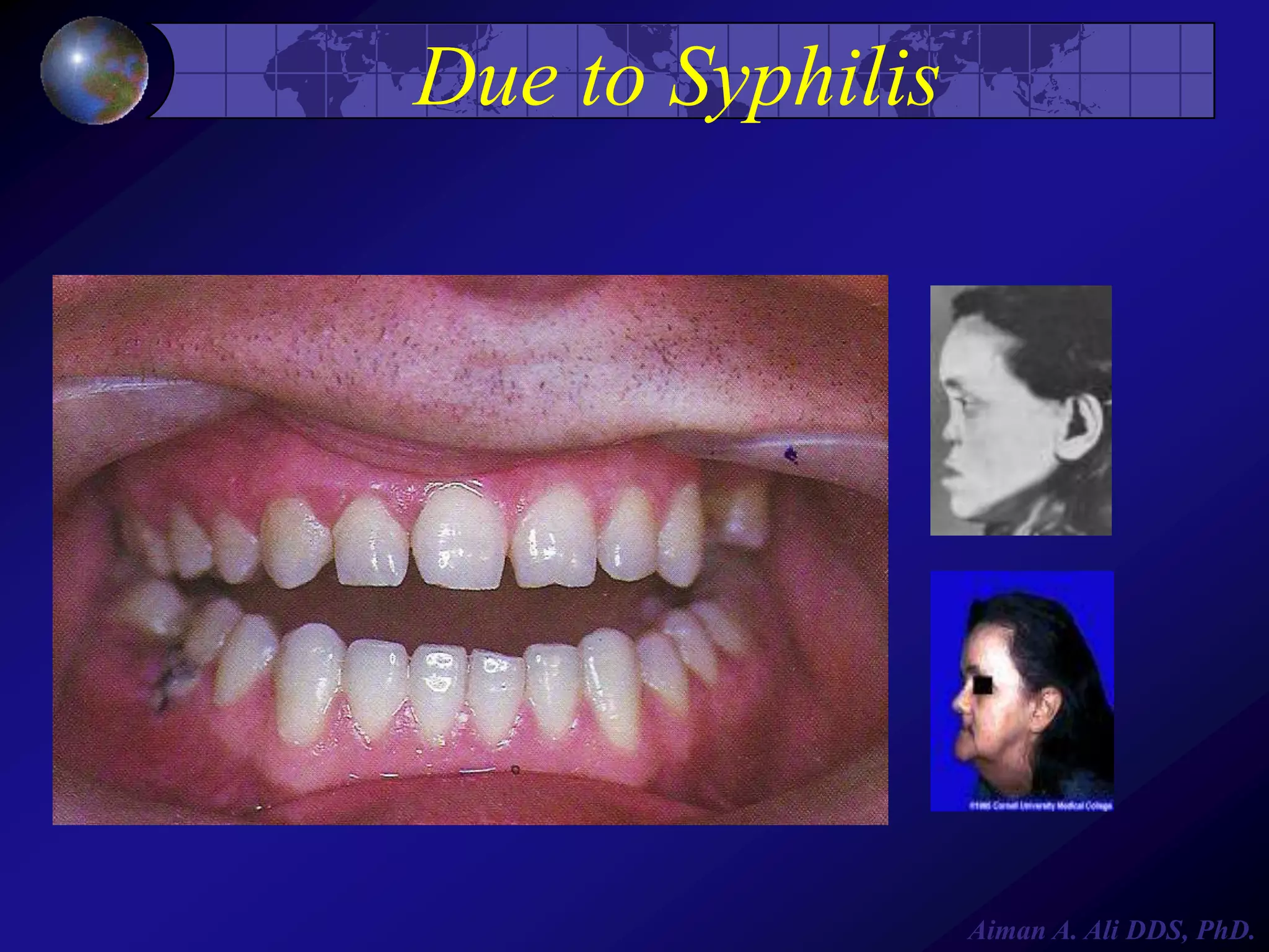 Due to Syphilis

Aiman A. Ali DDS, PhD.

 