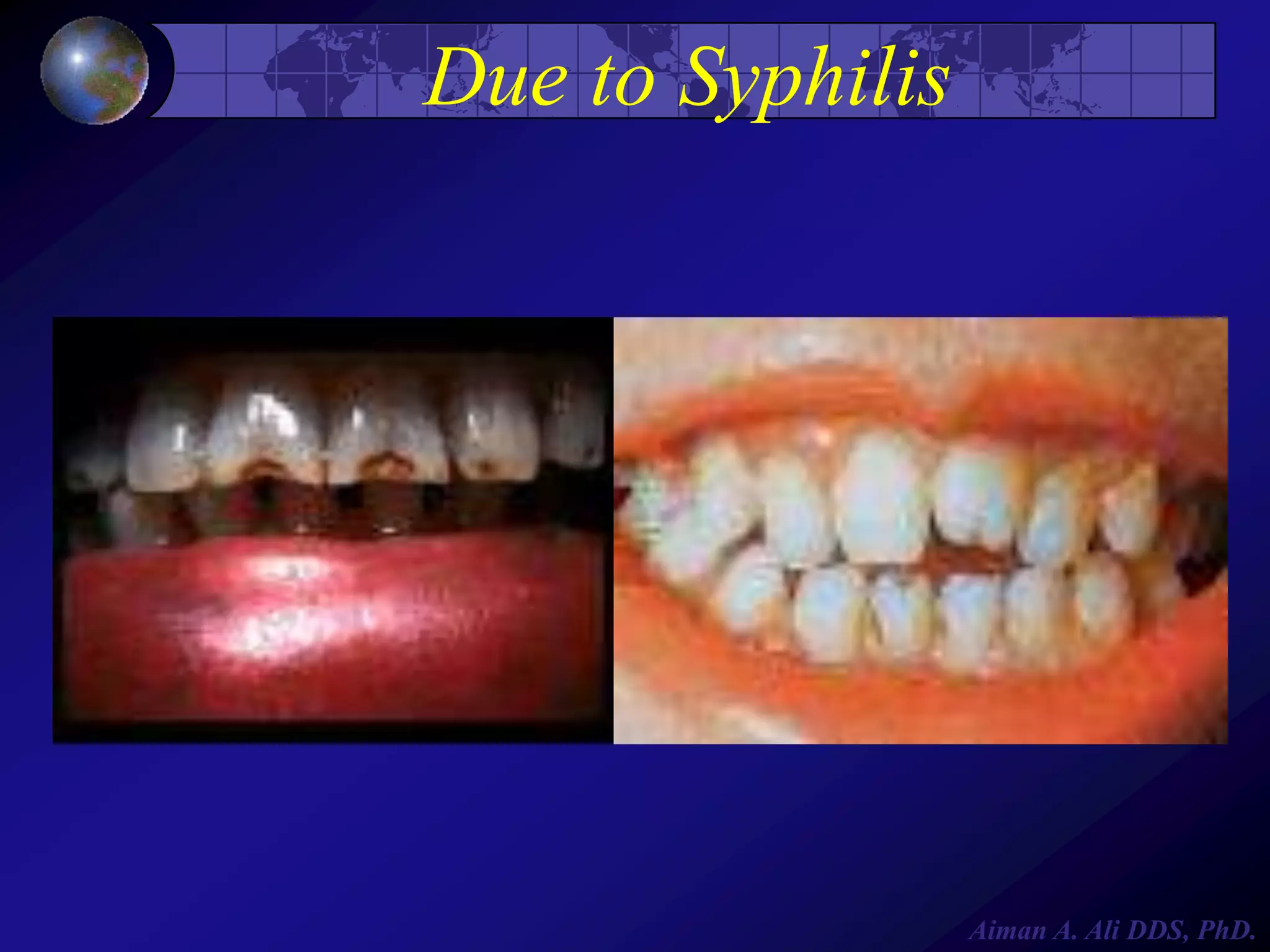 Due to Syphilis

Aiman A. Ali DDS, PhD.

 