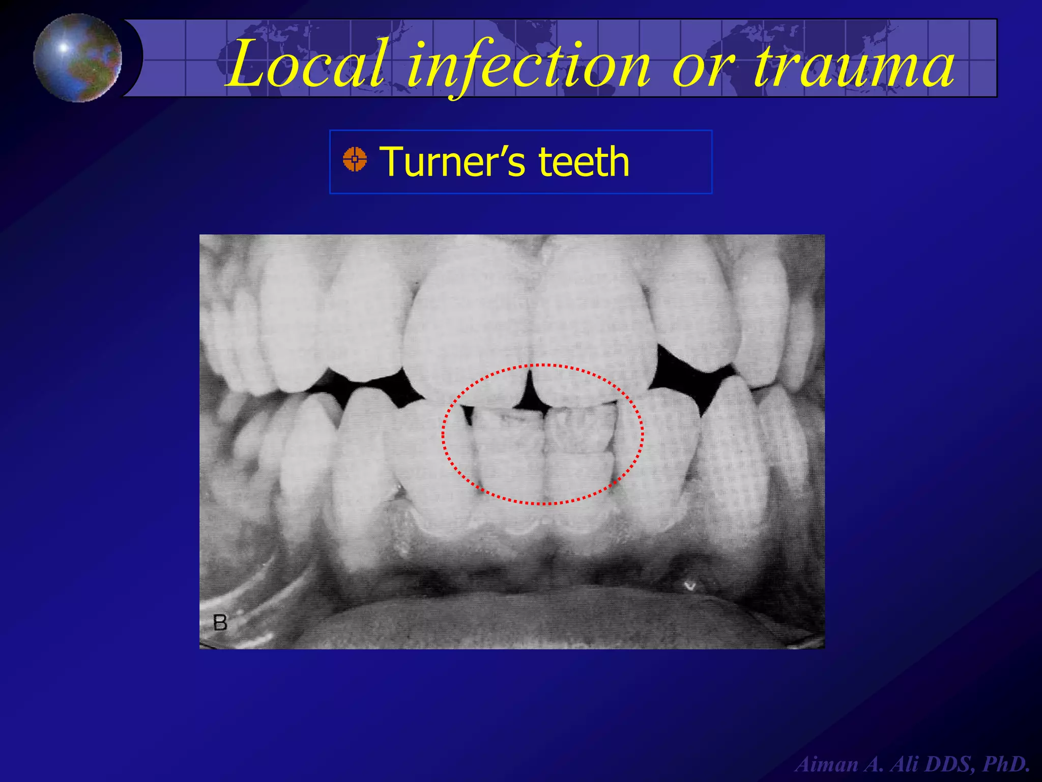 Local infection or trauma
Turner’s teeth

Aiman A. Ali DDS, PhD.

 